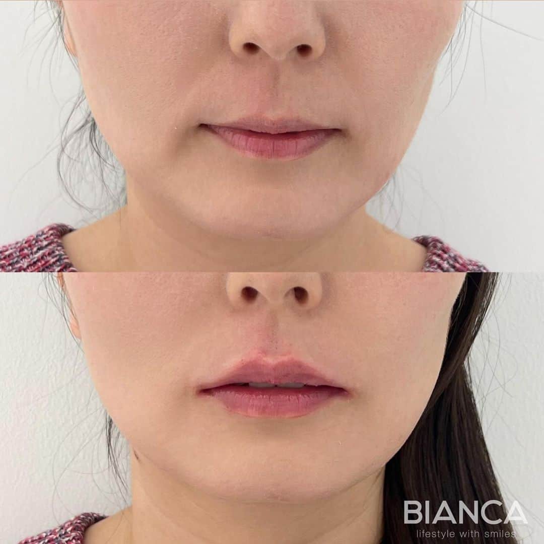 辻沢由有（BIANCA CLNIC 表参道院 院長）さんのインスタグラム写真 - (辻沢由有（BIANCA CLNIC 表参道院 院長）Instagram)「#dryuuヒアル  唇ヒアルロン酸はアンチエイジング効果も抜群❤️ 治療時間、約10分👏 ヒアルロン酸でここまで変えられます✨  どうなりたいかわからない方も こだわりがたくさんある方も 綺麗になりたい方、お任せください🥰  ✽.｡.:*・ﾟ ✽.｡.:*・ﾟ ✽.｡.:*・ﾟ ✽.｡.:*・ﾟ ✽.｡.:*・ﾟ  ✔︎唇ヒアルロン酸 Juvederm VOLBELLA 1ml  77,000円＋税 別途施術料　22,000円＋税  ⏳治療時間: 10分 🗓持続期間: 1〜2年 😷腫れ・内出血: 数日程度 ⚠️リスク: 感染・血流障害・凹凸など  ✽.｡.:*・ﾟ ✽.｡.:*・ﾟ ✽.｡.:*・ﾟ ✽.｡.:*・ﾟ ✽.｡.:*・ﾟ  📝ご予約はwebが便利です✨ プロフィール欄のリンクからご予約ください。 ※医師指名可能（“大久保医師指名”をクリック） ※診察料はかかりません🙅‍♀️ ※表参道院勤務が9割となっています。  📍BIANCA CLINIC ※お電話頂くと自動音声通話に繋がります。 ✔︎表参道院 ☎️05018071593 東京都港区南青山5-11-10  南青山511ビル 2F ✔︎銀座院 ☎️05031964834 東京都中央区銀座1-8-19 キラリトギンザ12F  •診療時間 10:00〜19:00 •年中無休（年末年始を除く）   ✽.｡.:*・ﾟ ✽.｡.:*・ﾟ ✽.｡.:*・ﾟ ✽.｡.:*・ﾟ ✽.｡.:*・ﾟ  #唇ヒアルロン酸  #eライン #横顔美人 #リップヒアルロン酸#ヒアルロン酸」12月2日 15時57分 - i_am_yuu__