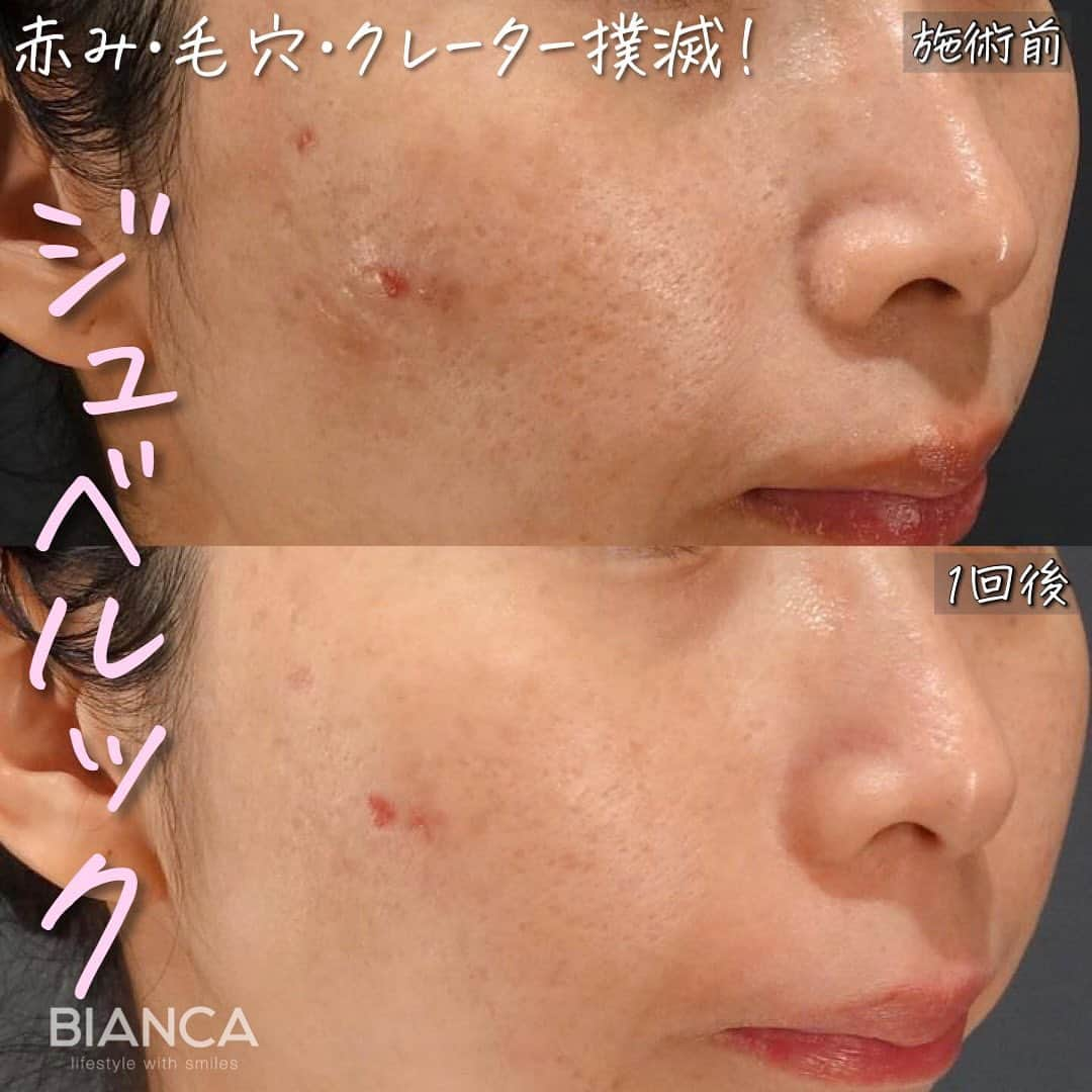 辻沢由有（BIANCA CLNIC 表参道院 院長）のインスタグラム：「最新スキンブースター✨ジュベルック💉  左:施術前 右:施術1回後  💡ジュベルック（Juvelook）とは…  PDLLA（ポリDL乳酸）による肌再生スキンブースター。 ジュベルックは非架橋ヒアルロン酸を混ぜる 注入剤で真皮層へ注入することで、コラーゲン生成を促し、肌内部を持ち上げて毛穴の開き、しわ、ニキビ跡を 目立たなくするなどの肌再生スキンブースター効果が 期待できる注入治療です。  くぼみの改善だけでなく、レーザーでは改善が難しい 赤みに対しても効果が認められている新しい注入剤です。  ジュベルックの成分であるPDLLA（ポリDL乳酸）は、 溶ける糸リフトや手術用縫合糸にも用いられている成分で、 1年〜2年かけてゆっくりと体内に吸収されていくため 効果の持続期間が比較的長いのが特徴です。  日本の厚生労働省にあたる、米国FDAと韓国KFDAの 承認を得ており安全性が認められる信頼のある 注入剤として注目されています。  韓国で、特に毛穴の開き改善に効果的ということで 爆発的にブームになっているジュベルックが 当院で受けられます🫶  💡ジュベルックの特徴  ・副作用、アレルギーが少ない ・効果の持続期間が長い ・局所注射ができる ・酸による炎症や異物反応が起こりにくい ・コラーゲンブースターとしての理想的な分子構造や 　条件を満たしている     💡施術間隔 1ヶ月おきに3回、その後半年〜1年後に メンテナンスを推奨します。  ✔︎ ジュベルック（Juvelook） •全顔  1回 110,000円   3回 297,000円  5回 440,000円  •局所（額・クマ・頬など）  1回 43,780円  3回 118,206  5回 175,120円  ✔︎ダウンタイム 赤み、腫れ、浮腫、内出血、膨疹、むくみが起こる ことがありますが時間の経過とともに改善し、 数時間〜２日間程度で消失します。  ✽.｡.:*・ﾟ ✽.｡.:*・ﾟ ✽.｡.:*・ﾟ ✽.｡.:*・ﾟ ✽.｡.:*・ﾟ  📝ご予約はwebが便利です✨ プロフィール欄のリンクからご予約ください。 ※医師指名可能（“大久保医師指名”をクリック） ※診察料はかかりません🙅‍♀️ ※表参道院勤務が9割となっています。  📍BIANCA CLINIC ※お電話頂くと自動音声通話に繋がります。 ✔︎表参道院 ☎️05018071593 東京都港区南青山5-11-10  南青山511ビル 2F ✔︎銀座院 ☎️05031964834 東京都中央区銀座1-8-19 キラリトギンザ12F  •診療時間 10:00〜19:00 •年中無休（年末年始を除く）   ✽.｡.:*・ﾟ ✽.｡.:*・ﾟ ✽.｡.:*・ﾟ ✽.｡.:*・ﾟ ✽.｡.:*・ﾟ  #ジュベルック #juvelook  #毛穴 #ニキビ跡 #赤ら顔 #クレーター #肌質改善 #スキンブースター」