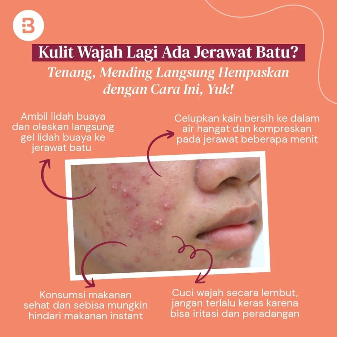 Beauty | Health | Fashionのインスタグラム：「Cara ini bisa langsung kamu cobain lho di rumah, gak perlu ribet ini-itu lagi, deh!🫡  Yuk, tetap semangat dan konsisten biar dapetin hasil yang maksimal.😋🤗  Beauties juga boleh share informasi ini ke bestie kamu yang lagi ngalamin jerawat batu, ya! —-- Jangan lupa untuk follow @Beautynesia.id  untuk berita menarik seputar wanita dan lainnya!  Follow juga instagram : @beautynesianews 💄 @mommyasia.id 🤰🏼👶🏻 —---- #kecantikan #beauty #tipskecantikan #perawatan #perawatanwajah #jerawatbatu #berjerawat #mukajerawatan #beautynesiaid」