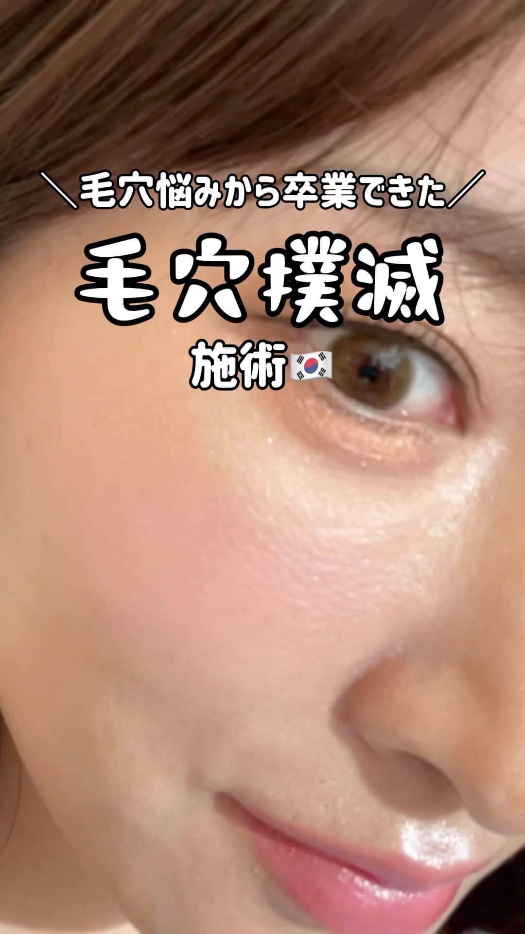 三井菜那のインスタグラム：「ジュベルックからの卒業🎓10月から受けてないけど毛穴悩みが本当になくなりました🇰🇷#韓国#韓国旅行#韓国美容#韓国#毛穴#ヨーグルト課金」