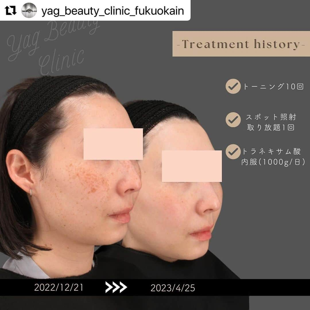 YAG BEAUTY CLINICさんのインスタグラム写真 - (YAG BEAUTY CLINICInstagram)「#Repost @yag_beauty_clinic_fukuokain with @use.repost ・・・ 🍍💛🍍💛 🍍💛 . .  いつもYAG BEAUTY CLINIC福岡院を ご利用いただきまして、 ありがとうございます🧡  こちらの患者様は ピコレーザートーニング10回  ＋ ピコスポット取り放題1回 をされており、治療歴は約4ヶ月です。  全体的にトーンアップし、 ソバカスもシミも肝斑も綺麗になっているのが 一目瞭然ですね…うっとり🥹♡  当院では2種類のトーニングの機械があります。 色味や深さ、種類、治療歴などをみて どちらがより良いかご提案しております。 今回はサイノシュア製のpicosureで 治療おこなっております🤍  Picosureはソバカスやシミ、 ADM（後天性真皮メラノサイトーシス）、 肝斑、くすみなどあらゆるお肌の 【茶色】に効果があります🧸  近頃はマスクをされない方も増えてきました。 気になるシミを早めに消して、 ノーファンデで過ごせるお肌を手に入れましょう🫶🏻🩵  お肌の悩みは十人十色 治療法も皆が皆同じわけではありません。 初回のカウンセリングはしっかりじっくりと 時間をかけてお話しさせて頂きます。 是非一度カウンセリングにお越しください💫 一緒に美肌を手に入れましょう🤝  皆様のご来院をスタッフ一同 心よりお待ちしております。」12月6日 15時47分 - yagbeauty_official