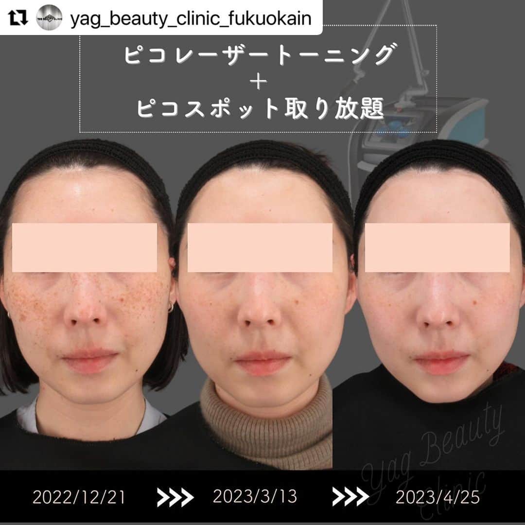 YAG BEAUTY CLINICのインスタグラム：「#Repost @yag_beauty_clinic_fukuokain with @use.repost ・・・ 🍍💛🍍💛 🍍💛 . .  いつもYAG BEAUTY CLINIC福岡院を ご利用いただきまして、 ありがとうございます🧡  こちらの患者様は ピコレーザートーニング10回  ＋ ピコスポット取り放題1回 をされており、治療歴は約4ヶ月です。  全体的にトーンアップし、 ソバカスもシミも肝斑も綺麗になっているのが 一目瞭然ですね…うっとり🥹♡  当院では2種類のトーニングの機械があります。 色味や深さ、種類、治療歴などをみて どちらがより良いかご提案しております。 今回はサイノシュア製のpicosureで 治療おこなっております🤍  Picosureはソバカスやシミ、 ADM（後天性真皮メラノサイトーシス）、 肝斑、くすみなどあらゆるお肌の 【茶色】に効果があります🧸  近頃はマスクをされない方も増えてきました。 気になるシミを早めに消して、 ノーファンデで過ごせるお肌を手に入れましょう🫶🏻🩵  お肌の悩みは十人十色 治療法も皆が皆同じわけではありません。 初回のカウンセリングはしっかりじっくりと 時間をかけてお話しさせて頂きます。 是非一度カウンセリングにお越しください💫 一緒に美肌を手に入れましょう🤝  皆様のご来院をスタッフ一同 心よりお待ちしております。」
