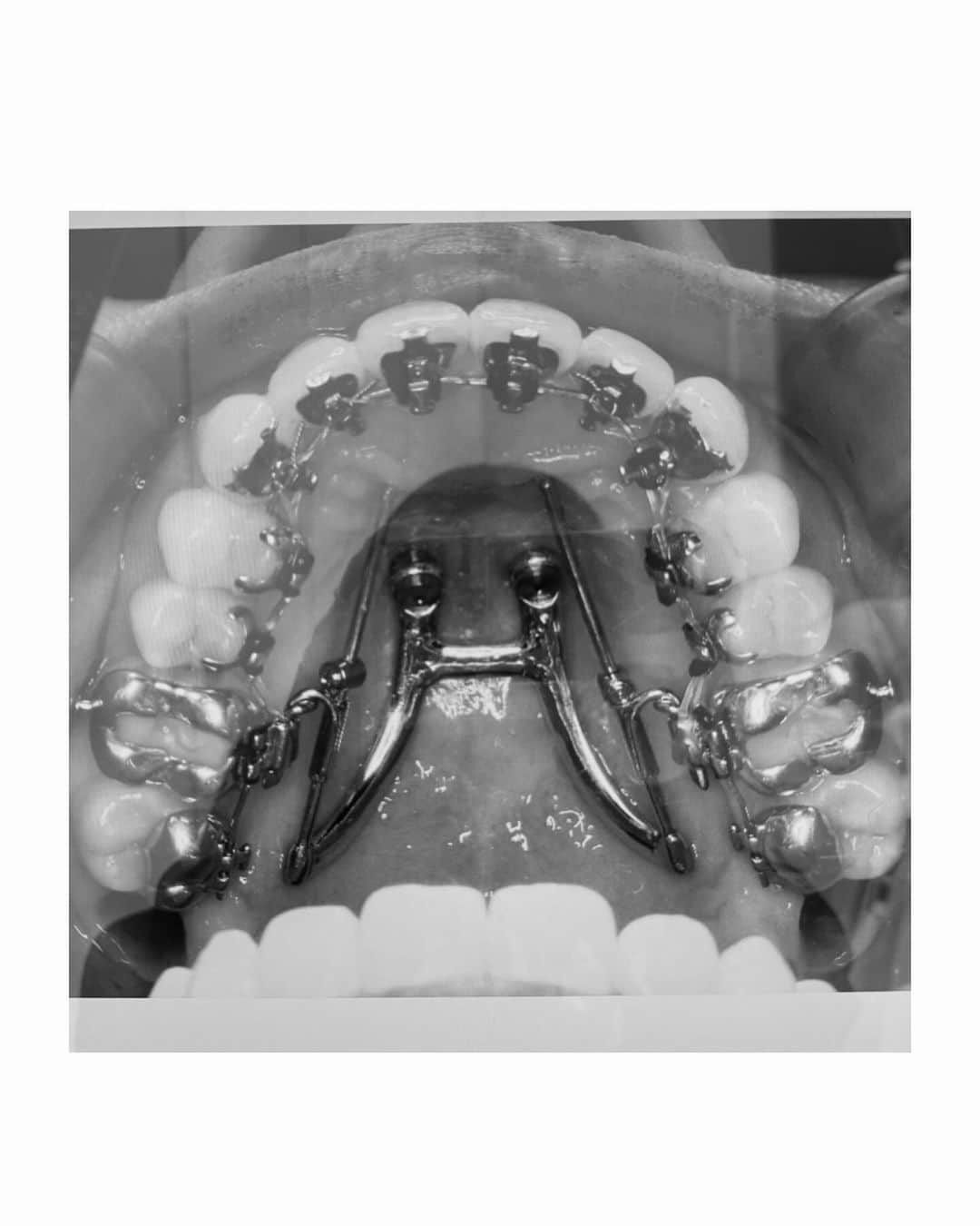 荻原桃子さんのインスタグラム写真 - (荻原桃子Instagram)「歯科矯正1年経過🦷✨  上の歯の歯並びが揃ってきて 下の歯も裏側矯正が数ヶ月前から始まって  今日はいよいよ上の親知らずを2本抜いて アンカースクリュー　シューライダー という上顎にピタッとはまる金属装置が設置  上の歯を1.5ミリから2ミリ後退させる為の装置で ここから一年近くこの装置と共に暮らす事に。  全ては綺麗になりたい🫶の為であり 自分で決めた事なんだけどさぁ  すんごい違和感。滑舌ヤバすぎ🤣  ワイヤーだけでも滑舌悪くて 食べ物の詰まりが半端なかったのに  こんな日に楽しみにしていた @marukeikorea の牡蠣キムチが届いたから 食べてみたら、、、  嘘でしょwってくらい牡蠣とニラが装置につまる🤣 小さいおつまみくらいつまる💦  好きすぎだから諦めずにたーっぷり食べたんだけどね🫶  これ。焼肉とかサラダとか恐ろしくて食べれないw  ワイヤーだけだと パナソニックのドルツ　ジェットウォッシャー で簡単にスッキリしてたんだけど  この装置はドルツだけでもスッキリしない、、、  もちろんドルツ無しだと話にもならない  いやぁ想像以上だよ🫨  綺麗になるって大変だわね、、、 美とはなんなんだ！  一年この装置つけた後は マウスピース生活も待ってるもんね〜💦  矯正仲間の皆様！励まし合って頑張ろう！  終わった後は絶対やって良かったって思えるもんね🦷✨  #歯科矯正記録」12月7日 22時24分 - momokoogihara
