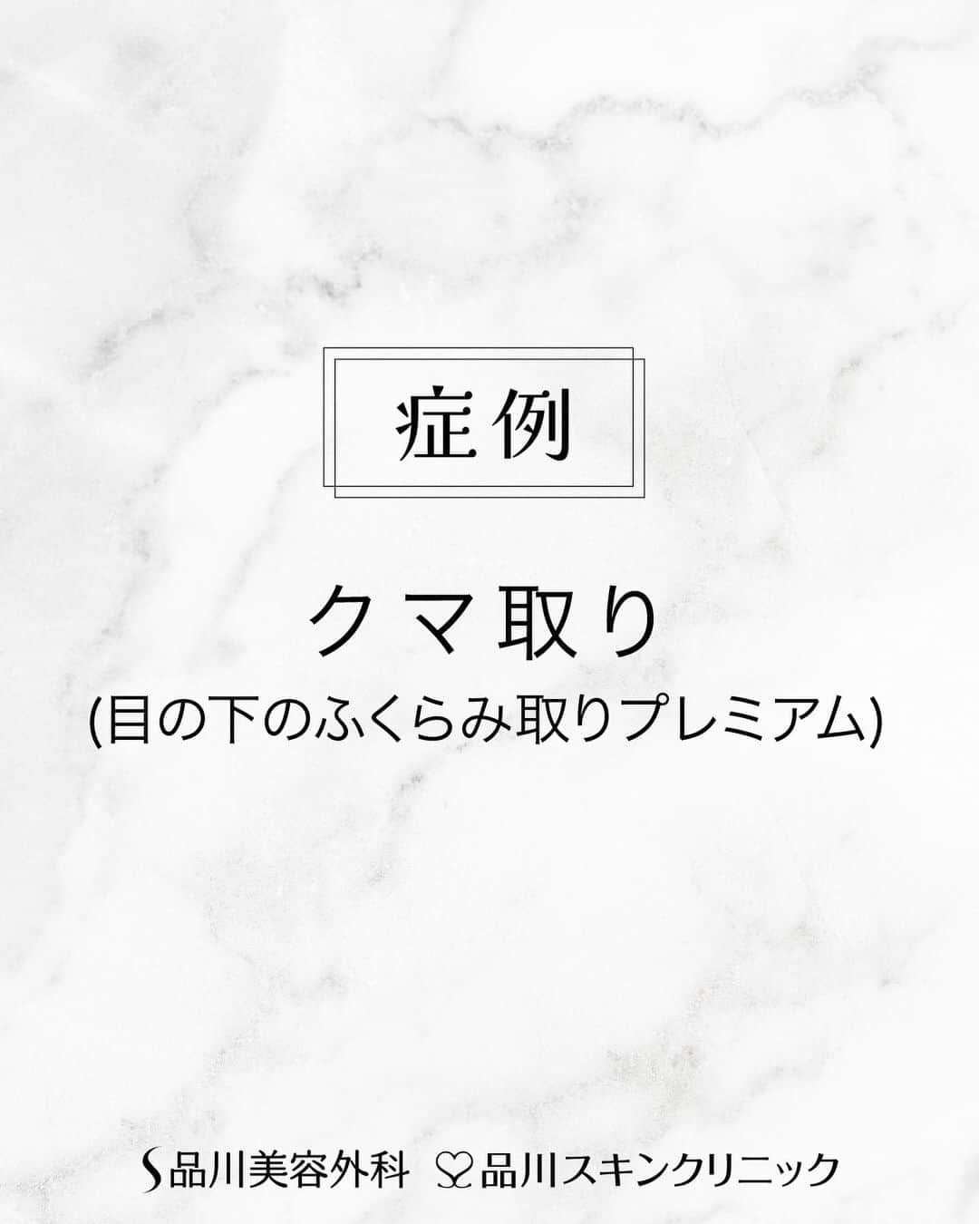 品川美容外科【公式】のインスタグラム：「1ヶ月後のお写真です✨ 目の下のクマ(ふくらみ)を除去し、若々しい明るい目もとへ❣️ 　　 💎施術名 目の下のふくらみ取りプレミアム 　　 💎担当医 品川美容外科 品川本院（@scs_shinagawa ) 方波見 有貴 医師 　　　　　 ┈┈┈┈┈┈┈┈┈┈┈┈┈┈┈┈　 　　 下まぶたの脂肪を除去する施術 【価格】204,050円～363,000円(税込) 【副作用・リスク】ハレ／痛み：2日～1週間位 内出血：1～2週間位 【TEL】0120-735-900 　　 ┈┈┈┈┈┈┈┈┈┈┈┈┈┈┈┈　　　   カウンセリングは無料です❣️是非ご相談ください✨   💎お問い合わせ 品川美容外科：0120-189-900 品川スキンクリニック：0120-575-900 プロフィール画面のURLからWEB予約が可能です💁 ▶@shinagawa.biyou   ※公的保険適用外となります。 ※掲載の全部または一部の治療は薬機法未承認の医療機器・医薬品を使用しています。医師の責任の下、個人輸入により治療を行っております。※個人輸入された医薬品等の使用によるリスク情報 https://www.yakubutsu.mhlw.go.jp/individualimport/   #品川美容外科 #品川スキンクリニック #美容 #美容医療 #美容皮膚科 #クマ取り #クマ治療 #目の下のふくらみ取り #エイジングケア」