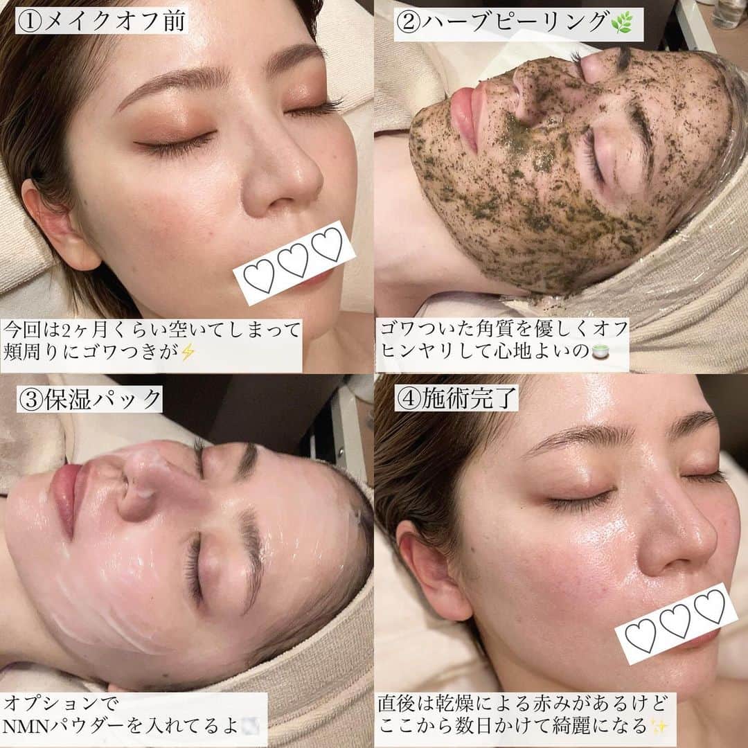 筒井愛実さんのインスタグラム写真 - (筒井愛実Instagram)「． \ リアル肌メンテ🌿 /  📍Luve 堂島店 剥離しないハーブピーリング💆🌿  今年の春に人生2回目、高校生以来ぶりに盛大に肌荒れしてしまった私の肌🧟💔  @ayumi_luve さんのおかげで、こんなに整いました🥹  剥離しないので、日常に影響しないし モデルを今でもたまにしている私にとってはすごくありがたい♡  施術日から数日かけてお肌が美しくなっていくので、毎日鏡を見るのが楽しい🪞  私はハーブピーリングにオプションでNMNのパウダーを＋していて、これが1番自分の肌キメが整う感じがしていて好き🫶  子どもの体調不良で今回は2ヶ月以上空いてしまったけど、今回はちゃんと月末の予約もしてきた✌️  大人になるとメンテの期間が空いてしまうといい状態を取り戻すのが大変なので、できる限り月1回はお肌のメンテをしてあげたい🥺  今月末も楽しみ♡ ． #Luve #ハーブピーリング #剥離しないハーブピーリング #美容 #肌メンテ #角質ケア」12月11日 8時39分 - manamin_158cm