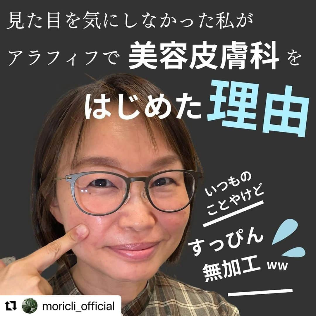 宋美玄さんのインスタグラム写真 - (宋美玄Instagram)「見た目を構う余裕がなく、野ざらしにしてきた私があるきっかけで美容医療を取り入れ、めっちゃ調子良くてハッピーになってることを日記に。 懐かしの、伝説の、すっぴんアエラ写真も。  #リポスト @moricli_official  ・・・ 当院が皮膚科、美容皮膚科をスタートして３ヶ月あまり。「院長美容日記」の連載をスタートします。 第1回目の今回は、当クリニックが美容皮膚科をはじめた理由から↓↓↓  こんにちは。丸の内の森レディースクリニックの宋です。 当院で美容皮膚科を開院し、4ヶ月が経過しました。私も早速あれこれ施術を受けたりしているので、セキララ美容レポートを、記録をかねて書いてみたいと思います。  40歳になったころ、ネットのコラムに「美人に生まれなくて良かった」という記事を書いたのですが、当時、結構な反響をいただきました。内容は「外見の美しさをアイデンティティの一つとして生きてきた人で、アラフォーになって若い頃の自分と比べてしまい、落ち込んだり、やりすぎなまでに美容医療に頼ったりする人がいるので、最初から外見がアイデンティティに関係なくて良かった」というものでした。  実際のところ、アラフォーくらいから肌のくすみ、シミ、たるみなどが気になり始める人は多いと思います。同世代の友人で、より手厚いケアをし始める人も増えました。私はその頃、2回の高齢出産により子育てが大変すぎた時期で、自分のことには全く構えず、美容院も年に1~2回しか行けないくらいでした。  ある時、仕事の合間に受けた週刊誌の取材で、写真撮影があると聞いていたのに全くメイクをする余裕がないまま取材に臨み、赤みもくすみもそのまま雑誌に載るという伝説を作ってしまいました。ママ友にも「あんた、さすがにあれはダメだよ」と言われてしまいました。  思わず「私は、見た目を売りにメディアに出ているんじゃないから」と言い訳しましたが、写真付きの取材にメイクをつけてもらうとプラス1時間くらいかかってしまうので、未就学児を育てながら馬車馬のように働き、本業以外にもインプットとアウトプットに追われていた私にはその1時間は捻出できなかったのです。実際、似たようなことが何度もあり、完璧に身繕いされた美しいタレントさんと、スッピンで髪もセットしていないまま一緒のページに載ったこともしばしば・・。 ある意味無敵？でした。  その後、コロナ禍がやってきて、毎日マスク生活。イベントも取材もオンラインがほとんどになって、画像処理でお肌がツヤツヤに見える機能の力も借りて、しばらく自分の中でもますます見た目を気にする機会は減りました。  そんな中、転換点となる出来事がありました。今年の春にテレビに出た時に、プロの方にメークしてもらったのですが、左頬の肝斑に6回コンシーラーを塗られたのです。長いマスク生活で摩擦のせいもあるのか、両頬の肝斑がだんだん濃くなっていくのは感じていました。  「やっぱり、目立つよな・・ 　この肝斑は公共の電波に乗せられないレベルなのか・・」  そんなわけで逃げずに直視せざるを得なくなり、皮膚科専門医の先生に相談。 まずは肝斑を薄くすることで、他の美容にチャレンジできる肌を作ろうということで、トラネキサム酸とビタミンCとビタミンEの内服を始めました。  これが美容日記の始まりです。もうかれこれ８ヶ月になりますが、毎日内服を続けている甲斐もあって、肝斑はかなり薄くなりました。 （もちろん内服以外にも対策を行っていますので追々お伝えします。。）  実は、私にはもともとアトピー性皮膚炎があり、敏感肌でほとんどの化粧品が使えません。メディアの仕事でメイクをしてもらう機会があると、その後数日はアトピー性皮膚炎用の軟膏をたっぷり塗って休めていないとダメなくらい、肌が弱いのです。  そんな私でも、保湿とUV対策ばかりじゃなく、攻めの美容がしたい！そこから始まった壮大な美容計画。ビフォーアフターの赤裸々な写真も交えつつ、院長やスタッフが経験した美容皮膚科の施術を解説しながら、痛みやダウンタイムの状況などを解説していこうと思います。 お楽しみに。  #美容皮膚科 #施術解説　#産婦人科 #ルメッカ #ハイフ #ボトックス #トラネキサム酸 #ビタミンC #肝斑 #丸の内で美容 #丸の内オアゾ #皮膚科　#丸の内の森レディースクリニック　#丸の内　#東京駅　#敏感肌　#敏感肌美容 #院長美容日記　#肌が弱い　#美容施術 #ipl」12月11日 17時51分 - mihyonsongkobe