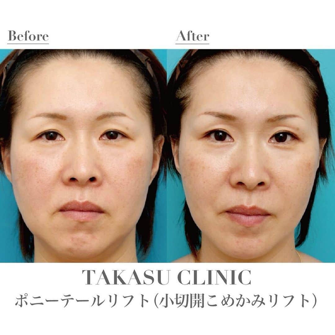 高須クリニック名古屋院のインスタグラム：「#repost @takasumikiya via @PhotoAroundApp  ポニーテールリフト（小切開こめかみリフト） ⁡ ポニーテールリフト（小切開こめかみリフト）でたるみを改善された方。リフトアップ効果で、下がり気味だった眉毛や目が引き上げられ、顔立ちにメリハリが出ました。またあごなどのフェイスラインもくっきり。手術前より小顔に見えます。 ポニーテールリフト（小切開こめかみリフト）は、切開部が少なく、糸を入れることでリフトアップ効果を出す施術なので、術後の腫れや痛みもわずかです。 ⁡ 【料金】 ●ポニーテールリフト（小切開こめかみリフト） ¥660,000（税込） 【銀座高須クリニック、横浜、名古屋、大阪】 ⁡ 【リスク・副作用・合併症】 ●ポニーテールリフト（小切開こめかみリフト） 側頭部の傷跡の一時的な盛り上がり（術後／効果に影響はありません） 仕上がりのわずかな左右差（完璧なシンメトリーは不可） 感覚が鈍くなる可能性 ⁡ ⁡ 【ご予約・お問い合わせ】 名古屋院☎︎ 052-564-1187 名古屋院📱 @takasuclinic_nagoya ↑名古屋院インスタのプロフィール画面からも直接コンタクトが取れます📲 https://www.takasu.co.jp/ ⁡ ⁡ #高須クリニック #高須クリニック名古屋院 #高須幹弥 #高須英津子 #美容整形 #整形  #ヒアルロン酸  #たるみ #しみ #シワ #ほうれい線  #ポニーテールリフト #小切開こめかみリフト #たるみ改善 #ビフォーアフター」