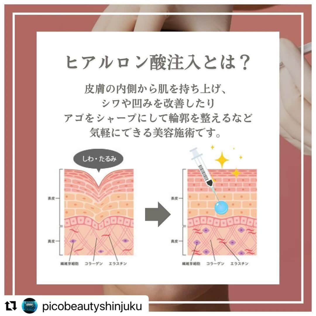 YAG BEAUTY CLINICさんのインスタグラム写真 - (YAG BEAUTY CLINICInstagram)「#Repost @picobeautyshinjuku with @use.repost ・・・ 日本人は顎がない？！ Eラインってなに？？美しい顔のバランスって？？ 顎ヒアルロン酸について解説してます🤓 是非一度当院にてご相談下さいませ💁‍♀️💜  ご予約・お問い合わせにつきましては当院までお電話お待ち致しております🙇‍♀️ 💎PICO BEAUTY CLINIC💎 〒160-0022 東京都新宿区新宿3-29-17新盛堂ビル8階 📲0120-900-253  #美容クリニック #美容外科 #美容皮膚科 #美容看護師 #picobeautyclinic #ピコビューティークリニック #ピコレーザー #新宿三丁目 #新宿 #ピコシュア #ピコトーニング #ピコフラクショナル#ピコスポット #シミ取り #シミ取り放題 #ピコシュアならピコビューティークリニック  #肌育  #アンチエイジング　#スキンケア #美白ケア #ダウンタイム #若返り #肌治療 #フェイスライン #ヒアルロン酸とは #口ごぼ #症例写真 #顎ヒアルロン酸 #ヒアルロン酸注入   @yagbeauty_official」12月13日 15時23分 - yagbeauty_official