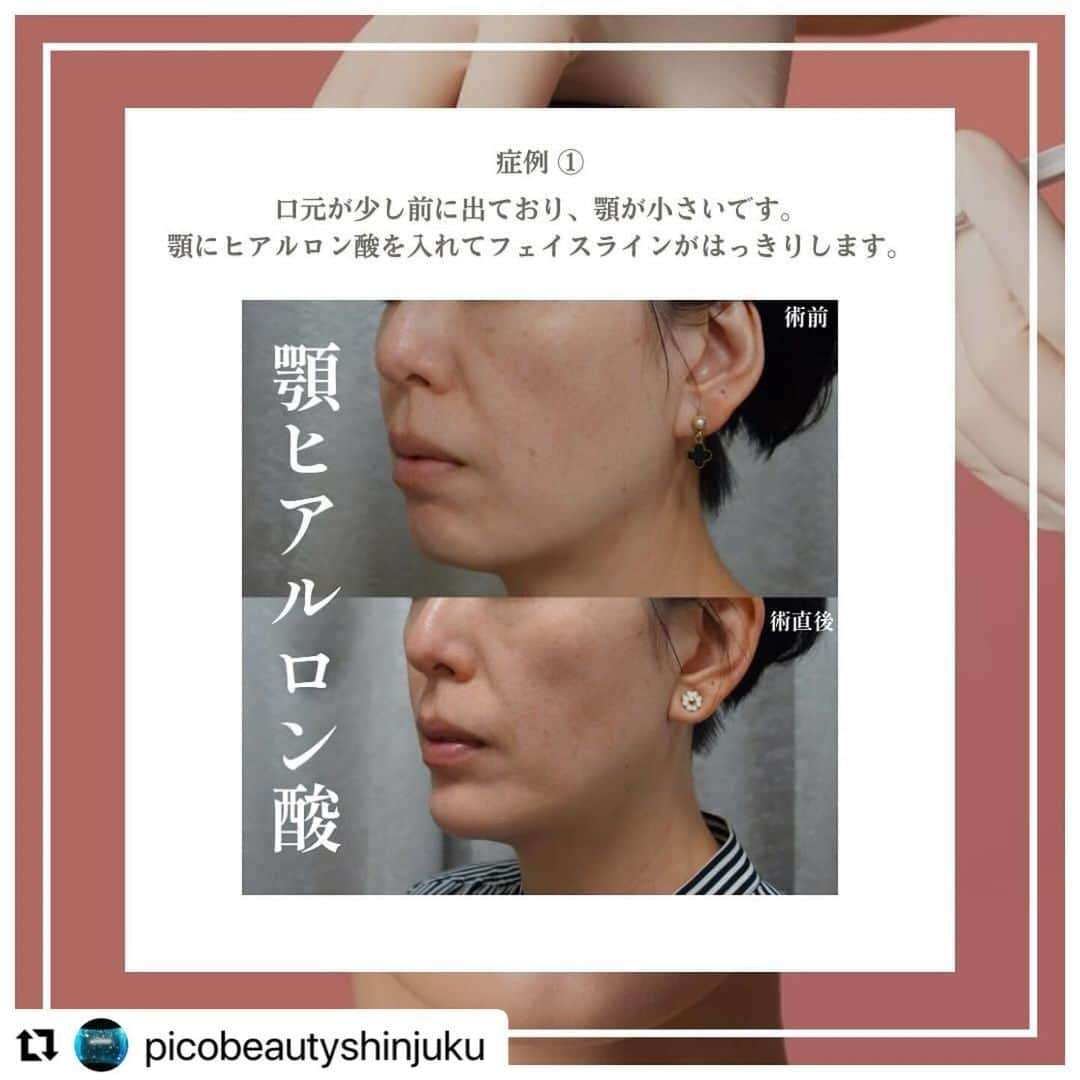 YAG BEAUTY CLINICさんのインスタグラム写真 - (YAG BEAUTY CLINICInstagram)「#Repost @picobeautyshinjuku with @use.repost ・・・ 日本人は顎がない？！ Eラインってなに？？美しい顔のバランスって？？ 顎ヒアルロン酸について解説してます🤓 是非一度当院にてご相談下さいませ💁‍♀️💜  ご予約・お問い合わせにつきましては当院までお電話お待ち致しております🙇‍♀️ 💎PICO BEAUTY CLINIC💎 〒160-0022 東京都新宿区新宿3-29-17新盛堂ビル8階 📲0120-900-253  #美容クリニック #美容外科 #美容皮膚科 #美容看護師 #picobeautyclinic #ピコビューティークリニック #ピコレーザー #新宿三丁目 #新宿 #ピコシュア #ピコトーニング #ピコフラクショナル#ピコスポット #シミ取り #シミ取り放題 #ピコシュアならピコビューティークリニック  #肌育  #アンチエイジング　#スキンケア #美白ケア #ダウンタイム #若返り #肌治療 #フェイスライン #ヒアルロン酸とは #口ごぼ #症例写真 #顎ヒアルロン酸 #ヒアルロン酸注入   @yagbeauty_official」12月13日 15時23分 - yagbeauty_official