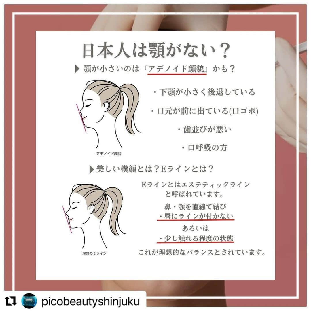 YAG BEAUTY CLINICさんのインスタグラム写真 - (YAG BEAUTY CLINICInstagram)「#Repost @picobeautyshinjuku with @use.repost ・・・ 日本人は顎がない？！ Eラインってなに？？美しい顔のバランスって？？ 顎ヒアルロン酸について解説してます🤓 是非一度当院にてご相談下さいませ💁‍♀️💜  ご予約・お問い合わせにつきましては当院までお電話お待ち致しております🙇‍♀️ 💎PICO BEAUTY CLINIC💎 〒160-0022 東京都新宿区新宿3-29-17新盛堂ビル8階 📲0120-900-253  #美容クリニック #美容外科 #美容皮膚科 #美容看護師 #picobeautyclinic #ピコビューティークリニック #ピコレーザー #新宿三丁目 #新宿 #ピコシュア #ピコトーニング #ピコフラクショナル#ピコスポット #シミ取り #シミ取り放題 #ピコシュアならピコビューティークリニック  #肌育  #アンチエイジング　#スキンケア #美白ケア #ダウンタイム #若返り #肌治療 #フェイスライン #ヒアルロン酸とは #口ごぼ #症例写真 #顎ヒアルロン酸 #ヒアルロン酸注入   @yagbeauty_official」12月13日 15時23分 - yagbeauty_official