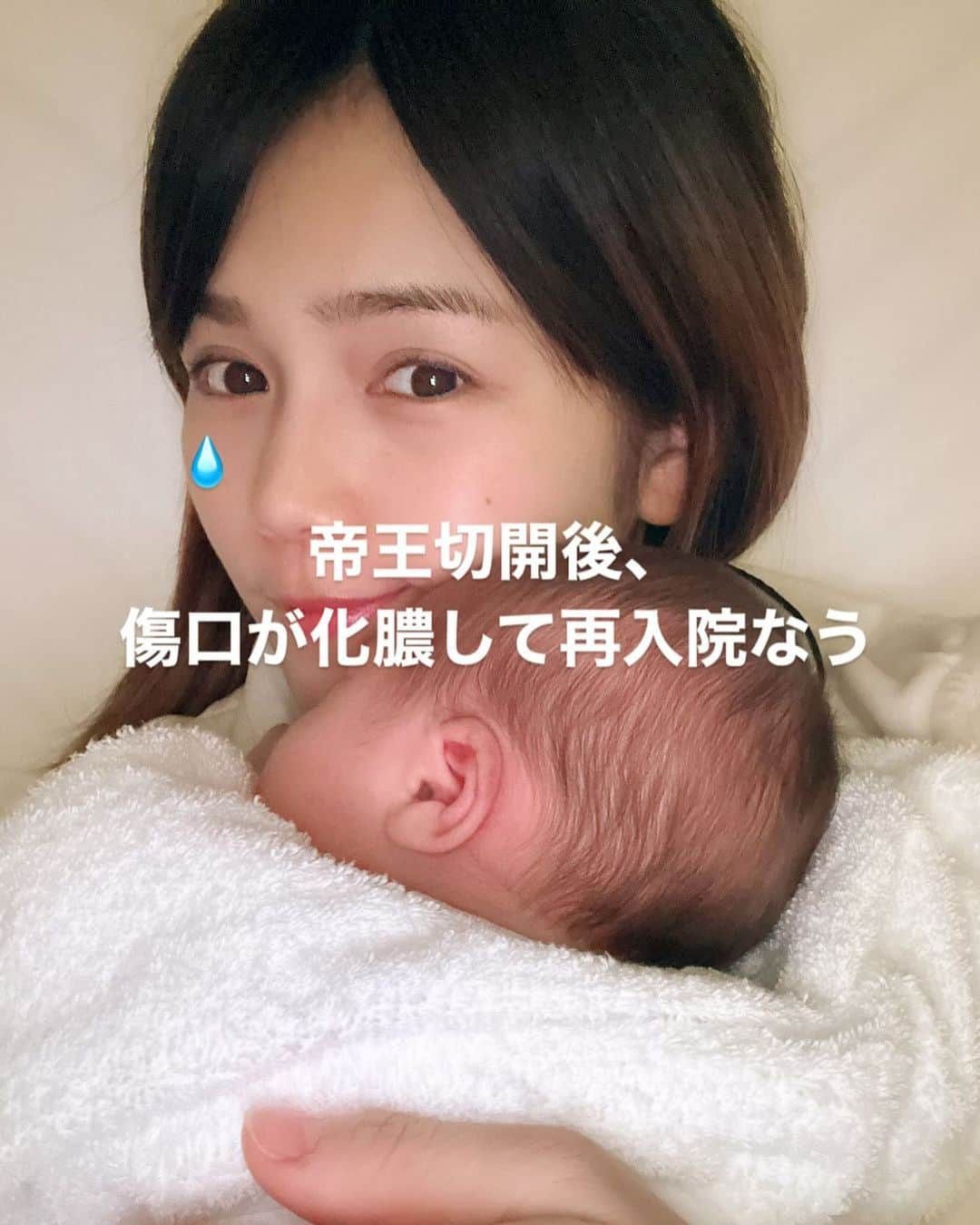 沢辺りおんさんのインスタグラム写真 - (沢辺りおんInstagram)「無痛分娩だったので 気持ち的にはカナリ余裕だった私。  「稀に麻酔が効かない方も居るので ご了承下さい」  と言われてましたが、  周りの先輩ママ達も 「全然痛くなかったよ！」 「余裕だった！」 という話しを聞いていたので もうお腹も苦しかったし早く出てこないかな〜🤰 なんて思ってた所に陣痛が。  病院に行って子宮口がまだ2cmしか開いてないとの事。  「え、こんなに痛いのにまだ2cm?」 と思ったけどそれは黙っておいた。  その後、お腹の赤ちゃんの心音確認中に破水。 そのまま入院することになり  「どうします？もう麻酔入れます？」  「お願いします」  食い気味で2つ返事でお願いした。  麻酔効いてくると大分楽になり お母さんはこの痛みに耐えて産んでくれたんだ。本当にすごいな。と思い母に感謝のメッセージを送った。  ですがこの後、私に麻酔は1時間半しか効かず 「稀に麻酔効かない方も居るのでご了承ください」 側の人になってた。  恥骨の部分からお尻にかけて割り箸で ブッ刺される痛みが定期的にきて  「これもう陣痛じゃん」 「無痛分娩なんじゃないの？」 「話が違うよ」  痛さと悔しさで泣きじゃくった。  先生に 「恥骨のあたりから肛門にかけてが死ぬほど痛いです」  というと  「そこは効きずらいんだよね〜 足します。」  と、足してもらったけど中々効かず 4時間後位にやっと落ち着いたと思いきや  先生がバタバタしだして  「子宮口9.5センチまで開いてるんだけど、赤ちゃんの心音が下がってます。 今すぐ出さないと行けない。 緊急帝王切開です」  逆にここでは麻酔効きまくっちゃってて 意識朦朧としながら 「はい」 と返事をし  その30分後に我が子誕生👶🏻  無事に帝王切開が終わり赤ちゃんと感動の対面をしたのもつかの間、ここから私の「本当の戦い」でした。  まず、子供産んだらお腹がすぐへっこむと思ってた私。 しかし全くへっこまずだったので 産褥パンツのサイズをミスしました。 （妊娠前はAll Sサイズだったので、産後は一応M購入したけど全然Lが良かった） なんなら産み落とした後なのに体重も全く変わってなかったです。  後陣痛と帝王切開の傷の痛み、さらにここで パンツがきつくて苦しいのとで腹痛に更に磨きがかかってとにかく痛かった。  入院中はとにかく下腹部が痛くて 出産よりも産後がキツすぎて こんなに子宮収縮って痛いんだ😭😭 と、思ってました。  先生には「傷口も綺麗だし子宮収縮の具合もいいですよ」  と言われたので 予定通り退院。  歩くだけでも痛いし 痛み止めが効いてないと声も出せない。 とにかく下腹部がいたい。  身体もお腹が痛すぎて思うように動かず 我が子の面倒もみれなくて 終わりの見えない痛みに 本当に毎日泣いてた😭  もっと早く病院行けば良かったと今なら思えるけど 当時は帝王切開もしてるし我慢しなきゃなのかと思って。  でも流石に2週間経っても一向に改善されないので 病院行くと  「虫垂炎っぽい(盲腸)」と診断され  今すぐ入院か、家で抗生物質飲むかの2択で 家で抗生物質を飲むを選択したんですが 次の日の夜にはまた信じられない位の痛みがきたので 救急で病院に行ってそのまま入院することに。  色々検査してみた結果 虫垂炎ではなく 「膿症」と、診断。  帝王切開した傷口の中で化膿してどんどん膿が溜まって 腹痛を起こしてるとの事。  だから今までの痛みは後陣痛でも虫垂炎でもなかったってこと。  原因がわかって良かった😭　  虫垂炎だと思ってたから 虫垂炎について調べてたし 虫垂炎の痛みで当てはまってるやつばかりだったし、  ３大激痛に虫垂炎入ってたから だからこんなに痛いのかと思ってたのに  虫垂炎じゃないですって言われたら 「え、じゃあこれなんの痛みなの？！」  という原因不明の時間が半日くらいあって 原因がわかるまで入院もさせてもらえなかったから本当にしんどかった。  という事で原因がわかり すぐに我が子と一緒に入院生活。  抗生物質の点滴と 痛み止めの点滴。  点滴って本当にすごい！！ 痛みがかなり和らぎます。  そして 長い鉄の棒を傷口にいれ、傷口を開けて その中に洗浄液を入れて洗いながし 切開した傷口にガーゼを入れて そのガーゼに膿を染み込ませて膿を出すという施術。 これを麻酔なしで行います。  泣ける。 泣ける痛さしてる。  痛いと言っても手は止まらない施術。  今これを毎日やってる所です。  これから出産を控えるママさん達 帝王切開の傷口のは化膿する事があります！ 傷口が綺麗でも2〜3日経っても痛すぎたら 私みたいに後陣痛だと思わずに すぐに受診してください！  ちなみに膿症と診断されるまでも 痛みに耐えながら12時間程かかりました！ (これがかなりきつかった)  でもどんなに痛くても 我が子の顔をみると救われました😭  麻酔は効かないし 帝王切開になっちゃって 傷口も膿んで痛すぎたけど 赤ちゃんが無事に産まれて来てくれて本当によかった。  今は娘、🐰ちゃんと2人の入院生活を 楽しみます🍼  #産後 #帝王切開 #膿症」12月21日 12時31分 - rionsawabe