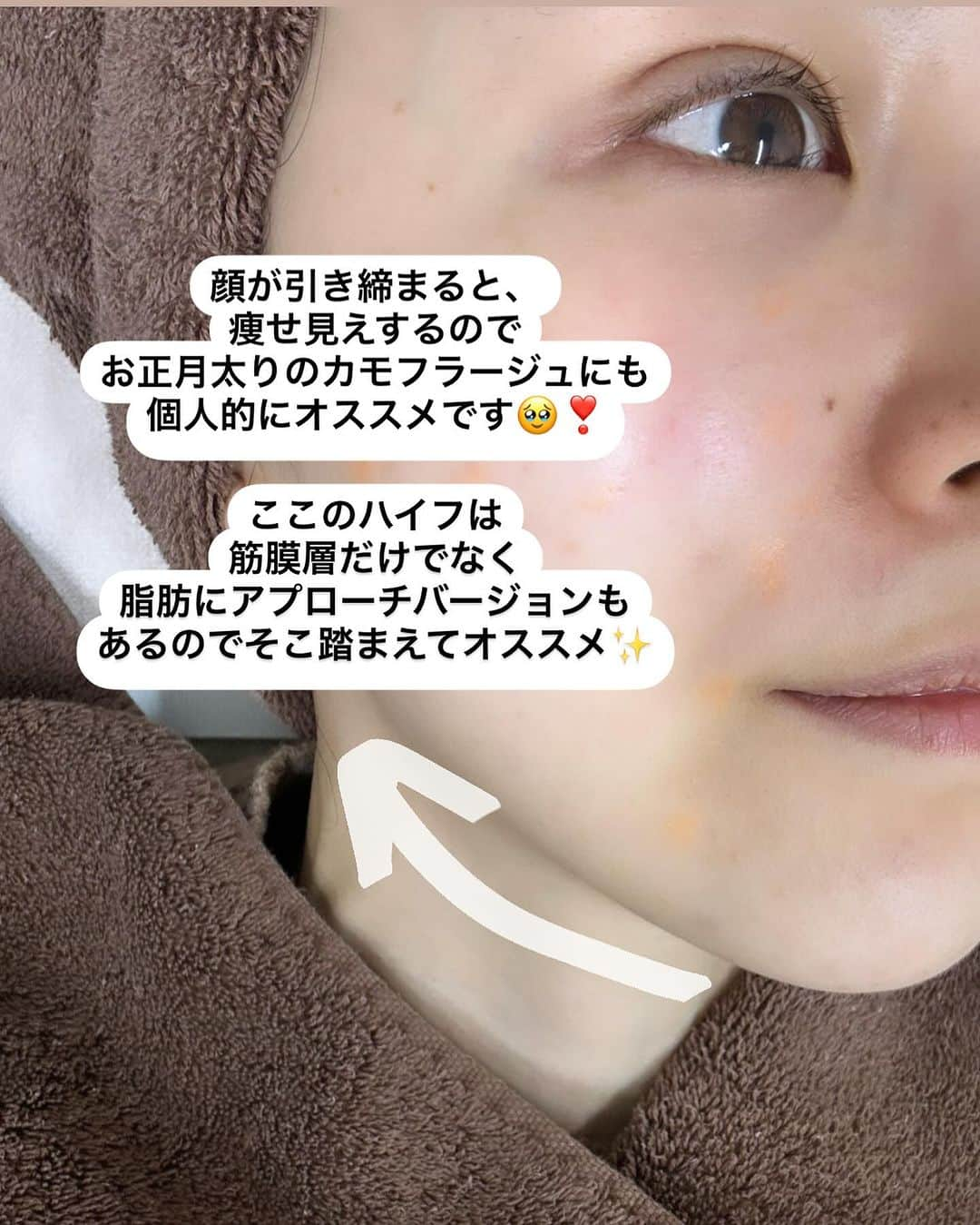 りーまるさんのインスタグラム写真 - (りーまるInstagram)「📍@juno_beauty_clinic_shinjuku ハイフしてきました〜❣️  ハイフといえば、 すこーし痛いのを想像すると思うのですが、 全く痛くなくてびっくり！！  私は 顎下、顔周り中心にやってもらいました🥰  クリニックは新宿高島屋のすぐ近く✨ 施術してくれたお姉様も優しくて、 とてもいいクリニックでした😭❤️  #PR  #AND美容外科 #AND美容外科でなりたい自分に  #美容 #美容クリニック #美容整形#美容医療 #女子力アップ #美容オタク #美容マニア #美容垢 #美容女子 #垢抜ける方法#JUNO_for_WOMEN #ATOM_for_MEN #ジュノビューティークリニック #アトムクリニック#顎下のたるみ#ハイフ東京#美容外科 ＃東京美容外科 #医療施術#新宿美容クリニック」12月28日 18時01分 - riii_maru162cm