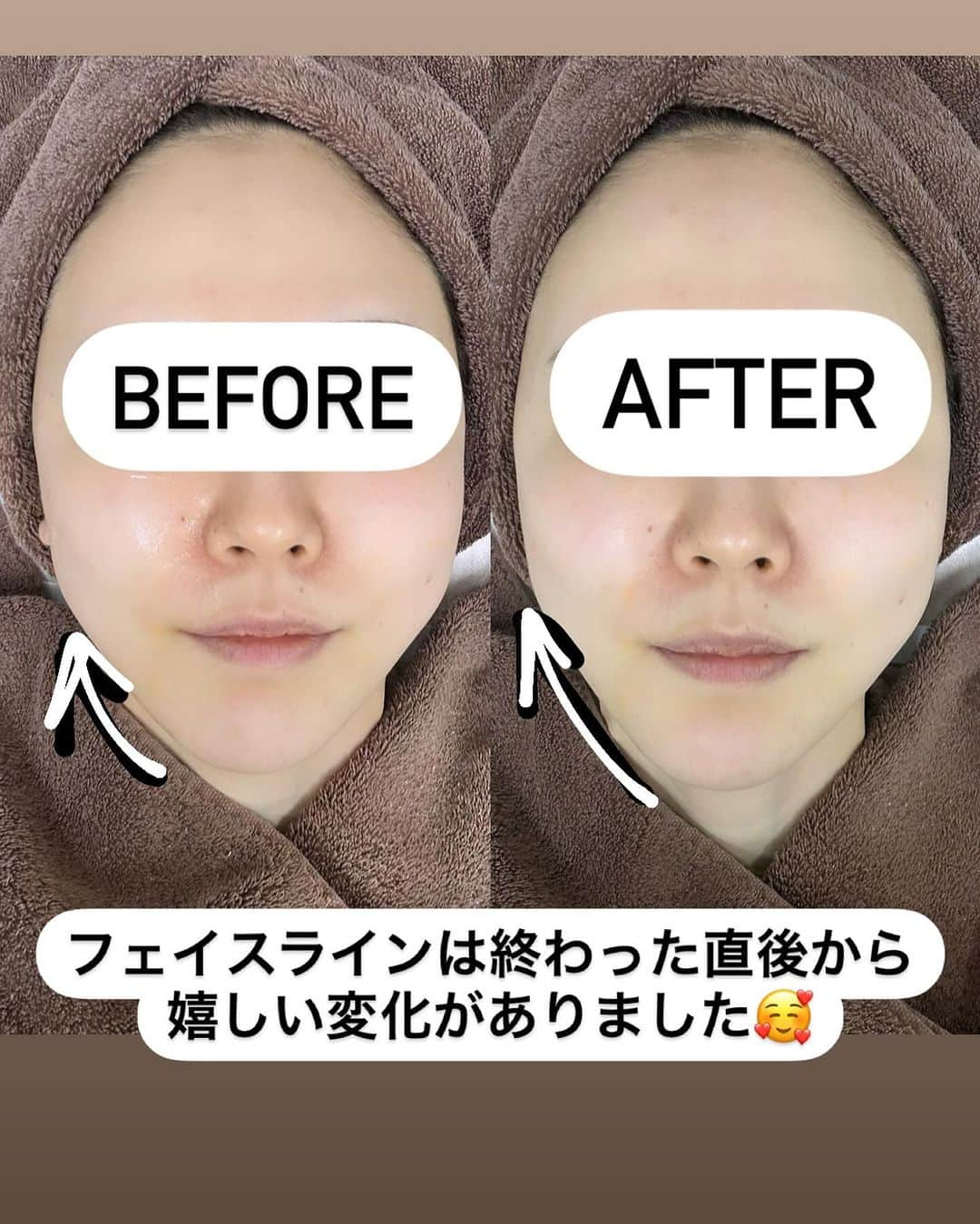 りーまるさんのインスタグラム写真 - (りーまるInstagram)「📍@juno_beauty_clinic_shinjuku ハイフしてきました〜❣️  ハイフといえば、 すこーし痛いのを想像すると思うのですが、 全く痛くなくてびっくり！！  私は 顎下、顔周り中心にやってもらいました🥰  クリニックは新宿高島屋のすぐ近く✨ 施術してくれたお姉様も優しくて、 とてもいいクリニックでした😭❤️  #PR  #AND美容外科 #AND美容外科でなりたい自分に  #美容 #美容クリニック #美容整形#美容医療 #女子力アップ #美容オタク #美容マニア #美容垢 #美容女子 #垢抜ける方法#JUNO_for_WOMEN #ATOM_for_MEN #ジュノビューティークリニック #アトムクリニック#顎下のたるみ#ハイフ東京#美容外科 ＃東京美容外科 #医療施術#新宿美容クリニック」12月28日 18時01分 - riii_maru162cm