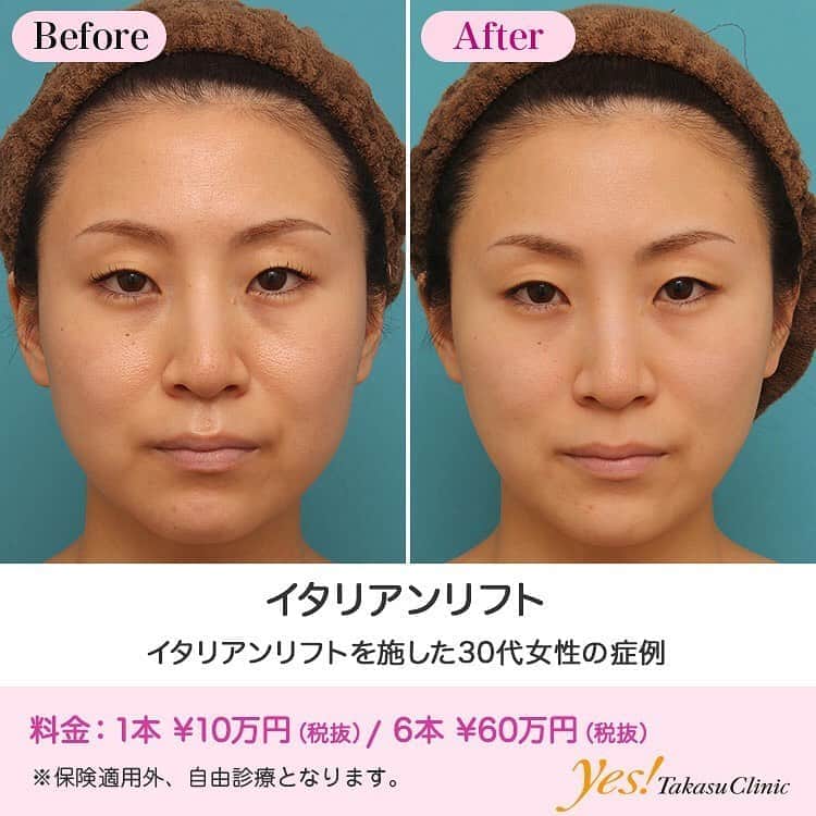 高須クリニックのインスタグラム：「👨🏻‍⚕️高須幹弥医師からのコメント✨⠀ 30代女性の患者様で、エイジングケア治療やたるみ治療を希望されていました。 診察させていただいたところ、年齢相応に顔全体がたるんでおり、特に頬やフェイスラインのたるみが目立っていました。 この患者様くらいのたるみの場合、ミニフェイスリフト（頬のたるみ取り）やミディアムフェイスリフトなどの切開する手術も適応になりますが、患者様のご希望は、まずは切らないリフトアップ治療をしたいということだったので、イタリアンリフトをすることになりました。 局所麻酔下に、頬からフェイスラインにかけて吸収糸を入れ、軽く引き上がるようにしました。 術後6ヶ月の時点には、頬~フェイスラインのたるみが程よく自然にリフトアップしました。 イタリアンリフトの糸は、挿入してから8~10ヶ月くらいで溶けて、溶けた部位に自己コラーゲン繊維が形成されます。 形成されたコラーゲン繊維はある程度永久的に残るため、手術を受けた時点から、半永久的に老化の予防をしてくれます。 この患者様くらいのたるみかけの顔に対して行うと、非常に効果的です。 ---------------------------------------------------- 🌈料金✨⠀ ●イタリアンリフト 1本 ¥100,000 / 6本 ¥600,000【全院】 ---------------------------------------------------- ⚠️リスク・副作用・合併症✨⠀ ●イタリアンリフト 麻酔による腫れ・内出血（術後） --------------------------------------------------- 😊施術についての詳細✨⠀⠀ https://www.takasu.co.jp/photo/italian019.html ---------------------------------------------------- 📞ご予約・お問い合わせ✨⠀ 0120-5587-10⠀ https://www.takasu.co.jp/cgi-bin/form/contact.cgi ※症例写真や施術に関するご質問なども上記までお願い致します。 ---------------------------------------------------- #イタリアンリフト #リフトアップ #頬のたるみ #フェイスラインのたるみ #たるみ改善  #皮膚 #美容 #美肌 #エイジングケア #美容整形 #美容外科 #美容クリニック #美容好き #美容皮膚科 #モニター #モニター募集 #高須クリニック #高須クリニック名古屋 #高須幹弥 #整形したい #プチ整形 #症例 #症例写真 #可愛くなりたい #可愛い #美人」