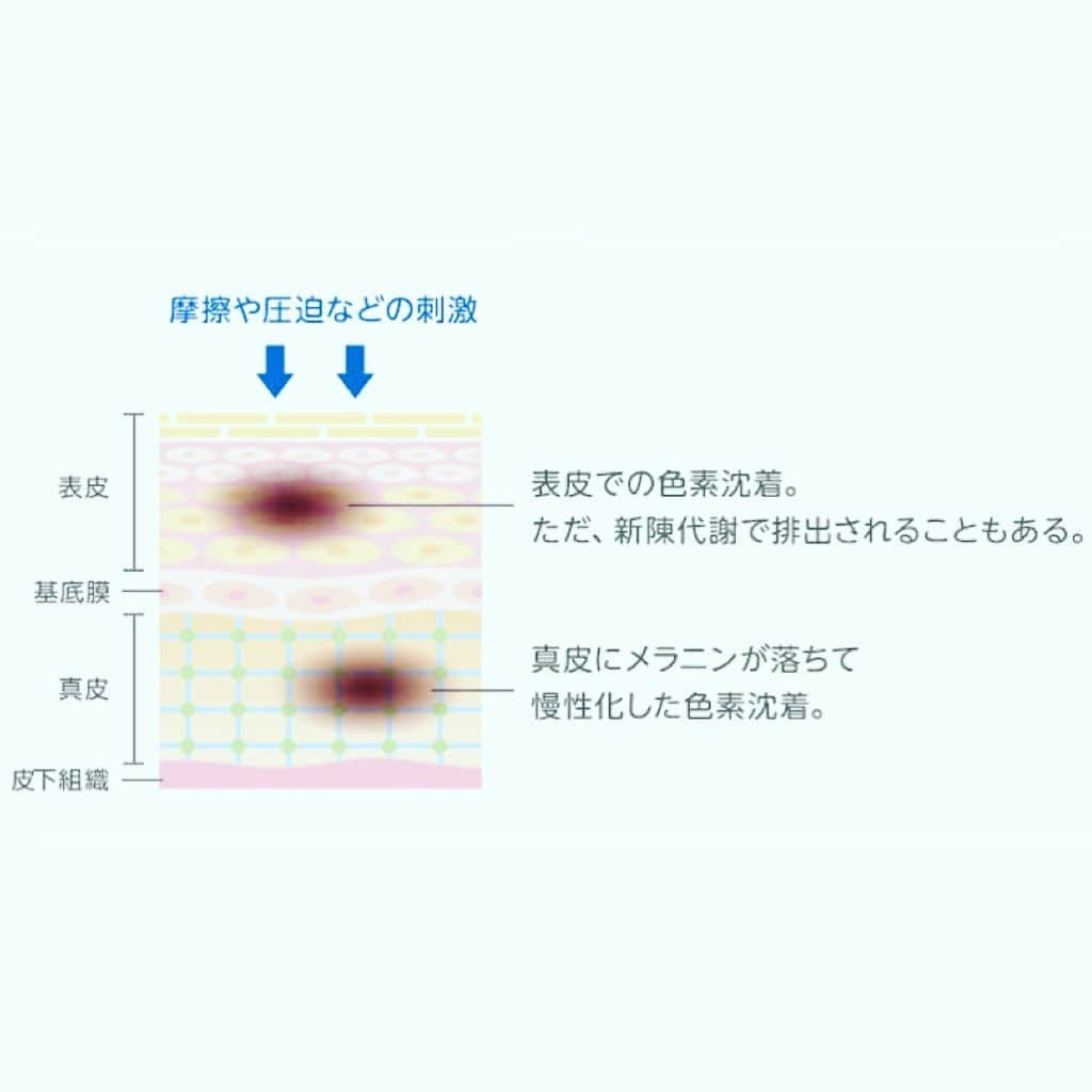 kogao283さんのインスタグラム写真 - (kogao283Instagram)「顔のシミは、摩擦をおこすことでも発生します😨 例えば顔にかかった髪の毛は、 常に顔をはたいているのと同じこと。  これが摩擦となって顔のシミの原因となるのです。  髪の毛だけでも摩擦がおきるのですから、 直接肌に触れるスキンケアのやり方 にも注意しなければなりません。  すなわち、スキンケアや洗顔のときに肌をこすってしまうことがシミの原因となるのです。  肌をこすってしまうと摩擦で 肌の内側に赤い炎症が発生🔥  そこにメラニンが溜まって茶色いシミに なってしまうのです😨  これが顔のシミの原因になります。 泡たっぷりの泡洗顔をしなければなりません🌿  顔のシミが改善する可能性は大😱  実際、顔のシミに悩む女性のスキンケアの様子を見ると、かなり念入りに行っていることがわかります。しかも、顔のシミが多い場所は化粧も入念になるもの。結果的に、強くこすってしまう回数も増えてしまいます。  目の疲れの解消に、目のまわりをマッサージ することも顔のシミの原因になります。 マッサージはオイルや乳液などをたっぷり使って、 肌の摩擦を減らして行うようにしなければなりません。  逆にいえば、クセや習慣を治すだけで 顔のシミやたるみは改善させることができるということ😄  もちろん、摩擦を減らす効果が すぐ出るかは個人差があります😌  それでも続けることで、 顔のシミが改善する可能性は大といえるでしょう✨  #シミ#色素沈着#摩擦#美肌ケア  KOGAO283」5月12日 9時30分 - kogao283