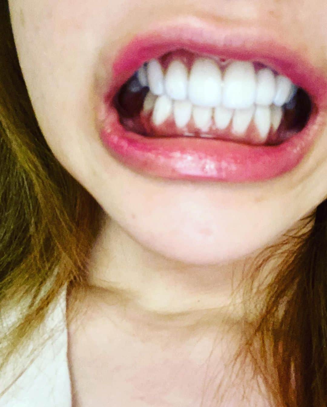 dj..琴さんのインスタグラム写真 - (dj..琴Instagram)「歯の器具取れました！(((o(*ﾟ▽ﾟ*)o)))わーい😆スッキリ！だけど、まだ、なんか違和感残る、、こんなゴツいネジと、、金具入ってたんだもんなー(@￣ρ￣@)顔の痺れももちろんある！。。時間と経過だろーな、、#良くなりますように🙏 #これでも病人です 笑 病人アピール半端ない！爆  9時消灯なので寝まーす(( _ _ ))..zzzZZ  また、話できず、 おや！！」5月14日 21時04分 - koto5555