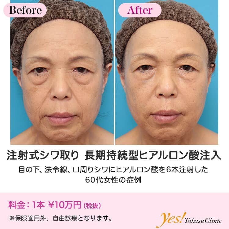 高須クリニックさんのインスタグラム写真 - (高須クリニックInstagram)「👨🏻‍⚕️高須幹弥医師からのコメント✨⠀ 60代女性の患者様で、顔全体のシワ、たるみの改善、エイジングケア希望で来院されました。 診察させていただいたところ、年齢相応に顔全体が老化しており、特に、上まぶた、下まぶたのたるみ、頬のたるみ、法令線、口周りのシワが目立っていました。 フェイスリフト、上まぶたたるみ取り、目の下のたるみ取りなどの切開する手術の適応がありますが、患者様は切る手術は望んでいませんでした。 切らない手術となると、イタリアンリフトなどの糸のリフトアップ治療、ウルセラシステムなどの照射系治療、ヒアルロン酸やボツリヌストキシンなどの注射による治療などが適応になります。 患者様に詳しくお話ししたところ、まずはヒアルロン酸注射で気になるシワを目立たなくすることになりました。 まずは、長期持続型ヒアルロン酸を、目の下のたるみの下のくぼみ、法令線、口周りのシワに計6本注射することになりました。 注射後は、目の下のたるみが少し目立たなくなって、法令線や口周りのシワが浅くなり、全体的に張りのある顔になりました。 今後、他の治療も合わせて行うと、更に効果的です。 ---------------------------------------------------- 🌈料金✨⠀ ●注射式シワ取り 長期持続型ヒアルロン酸注入 1本 ¥100,000【全院】 ---------------------------------------------------- ⚠️リスク・副作用・合併症✨⠀ ●注射式しわ取り 長期持続型ヒアルロン酸注入 内出血（注射針が血管に当たってしまった場合） 仕上がりのわずかな左右差（完璧なシンメトリーは不可） アレルギーが生じる可能性 注入後の感染 血流不全、皮膚壊死 過度にいじったり揉んだりすると腫れる可能性 --------------------------------------------------- 😊施術についての詳細✨⠀⠀ https://www.takasu.co.jp/photo/hyaluronic031.html ---------------------------------------------------- 📞ご予約・お問い合わせ✨⠀ 0120-5587-10⠀ https://www.takasu.co.jp/cgi-bin/form/contact.cgi ※症例写真や施術に関するご質問なども上記までお願い致します。 ---------------------------------------------------- #注射式シワ取り #長期持続型ヒアルロン酸注入 #ヒアルロン酸注入 #目の下のたるみ #法令線 #口周りのシワ #たるみの改善  #皮膚 #美容 #美肌 #エイジングケア #美容整形 #美容外科 #美容クリニック #美容好き #美容皮膚科 #モニター #モニター募集 #高須クリニック #高須クリニック名古屋 #高須幹弥 #整形したい #プチ整形 #症例 #症例写真 #可愛くなりたい #可愛い #美人」5月15日 16時56分 - takasu_staff