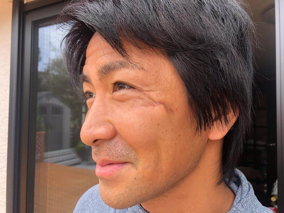 中町公祐さんのインスタグラム写真 - (中町公祐Instagram)「記録用 まぁ治らないよね、傷（笑） 傷は男の勲章か！ 初めて会った人が怖がらないといいけど（笑） ・ #顔に傷 #胸張って生きていこう #年取ったなしかし」5月15日 13時24分 - kosuke.machi