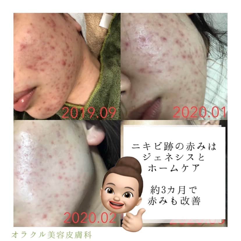 オラクル美容皮膚科東京新宿院さんのインスタグラム写真 - (オラクル美容皮膚科東京新宿院Instagram)「안녕하세요〜🤚﻿ ﻿ オラクル美容皮膚科﻿ 受付のUCHIMIです🥰﻿ ﻿ 実はオラクルに入社時はニキビで悩んでいました…﻿ ﻿ 去年の7月に上京してから慣れない東京生活で、ニキビが悪化していました。﻿ ﻿ そんな私が﻿ オラクル治療でここまでニキビ肌を改善することができました🥺✨✨✨﻿ ﻿ 私が、今までしてきた治療の中で特にニキビに効果があった治療をご紹介させて頂きます。﻿ ﻿ ★アグネス（全顔）﻿ ★BHAピーリング　﻿ ★ジェネシス﻿ ﻿ 2019.09から治療を開始して﻿ ﻿ ☑️アグネスを1回﻿ ☑️BHAピーリングを2週間に1回ペース﻿ ﻿ で治療を行いました。﻿ ﻿ コツコツ治療を続けた結果、2020.01頃には炎症はなくなりニキビ跡になりました😭✨﻿ ﻿ 炎症がなくなると、お肌のデコボコがなくなり、﻿ 赤みをコンシーラーでカバーすればお肌が綺麗に見えるので、お化粧が楽しくなりました🥰﻿ ﻿ 炎症ニキビが改善された後は、﻿ ニキビ跡の赤みが強く残っていたのですが…﻿ ﻿ 月に2回のジェネシスレーザーと、﻿ ホームケアでMTポアレスケアラインを使用したことで、3〜4カ月で赤みもとっても改善されました✨✨﻿ ﻿ 【Home care】﻿ ★MT クレンジングジェル﻿ ★MDEAR ホイップウォッシュ﻿ ★MT トーニングスムーサー﻿ ★MT CEBローション﻿ ★MT コンデンスCセラム﻿ ★EPL キュアクリームXD﻿ ﻿ カバー力が高いファンデーションとコンシーラーが無いと不安だった私ですが、今はゼオスキンのBSサンスクリーンとお粉のみのノーファンデ生活を送れています😭💗💗💗﻿ ﻿ 次は、毛穴治療にStep up予定です。。。✨﻿ ﻿ ニキビでお悩みの方、一緒にニキビ治療頑張ってみませんか？？？﻿ ﻿ 無料カウンセリングも行っておりますので、是非一度ご相談にいらしてください(^_^)✨✨﻿ ﻿ お待ち致しております！！！！！﻿ ﻿ ▪️▫️▪️▫️▪️▫️▪️▫️▪️▫️﻿ ﻿ 🇯🇵オラクル美容皮膚科🇰🇷﻿ 📍新宿3丁目19-4 MLJ新宿8階﻿ ﻿ 【専門】﻿ ニキビ（跡）／毛穴／シミ／しわ／たるみ／痩身／アンチエイジング／美白美肌全般／ブライダル相談／メンズ美容﻿ ﻿ 🗝完全予約制﻿ 👠土日祝日も診療﻿ ﻿ 【予約方法】﻿ ☎0120-905-696﻿ ⏰9:00～21:00［年中無休］﻿ ﻿ LINE、メール24時間📧﻿ LINE🆔 @oracle.jp ﻿ 📩HPメールフォームよりお願いいたします﻿ ﻿ ▪️▫️▪️▫️▪️▫️▪️▫️▪️▫️﻿ #オラクル美容皮膚科 #オラクル ﻿ #oracle #美容皮膚科  #肌管理 ﻿ #ニキビ #ニキビ跡 #ニキビ治療 #アグネス #ニキビケア #ニキビ跡ケア #ニキビ肌 #ニキビ改善 #ニキビ専門 #ニキビ皮膚科」5月16日 11時14分 - oraclejp