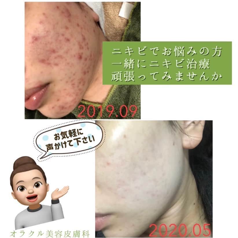 オラクル美容皮膚科東京新宿院さんのインスタグラム写真 - (オラクル美容皮膚科東京新宿院Instagram)「안녕하세요〜🤚﻿ ﻿ オラクル美容皮膚科﻿ 受付のUCHIMIです🥰﻿ ﻿ 実はオラクルに入社時はニキビで悩んでいました…﻿ ﻿ 去年の7月に上京してから慣れない東京生活で、ニキビが悪化していました。﻿ ﻿ そんな私が﻿ オラクル治療でここまでニキビ肌を改善することができました🥺✨✨✨﻿ ﻿ 私が、今までしてきた治療の中で特にニキビに効果があった治療をご紹介させて頂きます。﻿ ﻿ ★アグネス（全顔）﻿ ★BHAピーリング　﻿ ★ジェネシス﻿ ﻿ 2019.09から治療を開始して﻿ ﻿ ☑️アグネスを1回﻿ ☑️BHAピーリングを2週間に1回ペース﻿ ﻿ で治療を行いました。﻿ ﻿ コツコツ治療を続けた結果、2020.01頃には炎症はなくなりニキビ跡になりました😭✨﻿ ﻿ 炎症がなくなると、お肌のデコボコがなくなり、﻿ 赤みをコンシーラーでカバーすればお肌が綺麗に見えるので、お化粧が楽しくなりました🥰﻿ ﻿ 炎症ニキビが改善された後は、﻿ ニキビ跡の赤みが強く残っていたのですが…﻿ ﻿ 月に2回のジェネシスレーザーと、﻿ ホームケアでMTポアレスケアラインを使用したことで、3〜4カ月で赤みもとっても改善されました✨✨﻿ ﻿ 【Home care】﻿ ★MT クレンジングジェル﻿ ★MDEAR ホイップウォッシュ﻿ ★MT トーニングスムーサー﻿ ★MT CEBローション﻿ ★MT コンデンスCセラム﻿ ★EPL キュアクリームXD﻿ ﻿ カバー力が高いファンデーションとコンシーラーが無いと不安だった私ですが、今はゼオスキンのBSサンスクリーンとお粉のみのノーファンデ生活を送れています😭💗💗💗﻿ ﻿ 次は、毛穴治療にStep up予定です。。。✨﻿ ﻿ ニキビでお悩みの方、一緒にニキビ治療頑張ってみませんか？？？﻿ ﻿ 無料カウンセリングも行っておりますので、是非一度ご相談にいらしてください(^_^)✨✨﻿ ﻿ お待ち致しております！！！！！﻿ ﻿ ▪️▫️▪️▫️▪️▫️▪️▫️▪️▫️﻿ ﻿ 🇯🇵オラクル美容皮膚科🇰🇷﻿ 📍新宿3丁目19-4 MLJ新宿8階﻿ ﻿ 【専門】﻿ ニキビ（跡）／毛穴／シミ／しわ／たるみ／痩身／アンチエイジング／美白美肌全般／ブライダル相談／メンズ美容﻿ ﻿ 🗝完全予約制﻿ 👠土日祝日も診療﻿ ﻿ 【予約方法】﻿ ☎0120-905-696﻿ ⏰9:00～21:00［年中無休］﻿ ﻿ LINE、メール24時間📧﻿ LINE🆔 @oracle.jp ﻿ 📩HPメールフォームよりお願いいたします﻿ ﻿ ▪️▫️▪️▫️▪️▫️▪️▫️▪️▫️﻿ #オラクル美容皮膚科 #オラクル ﻿ #oracle #美容皮膚科  #肌管理 ﻿ #ニキビ #ニキビ跡 #ニキビ治療 #アグネス #ニキビケア #ニキビ跡ケア #ニキビ肌 #ニキビ改善 #ニキビ専門 #ニキビ皮膚科」5月16日 11時14分 - oraclejp