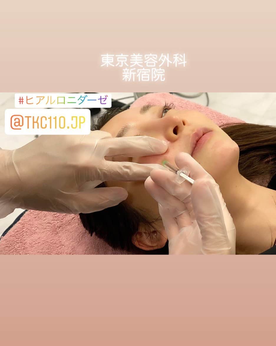 東京美容外科公式さんのインスタグラム写真 - (東京美容外科公式Instagram)「こんにちは、東京美容外科新宿院です。✨本日は、ヒアルロニダーゼのご紹介です。✨ ヒアルロン酸を注入後に修正する場合、まずヒアルロニダーゼという製剤を使用しヒアルロン酸を溶かし、その後、3週間から1か月程度間隔を空けてからヒアルロン酸を注入します。  体内にもともとあるヒアルロン酸 体内には元々ヒアルロン酸が存在しています。 ヒアルロニダーゼを注入すると、体内に元々あるヒアルロン酸も溶かしてしまいます。 しかしながら、体内に元々あるヒアルロン酸は、溶けてから数日以内に回復するため、ヒアルロニダーゼを注入してもほとんどの場合問題ありません。そのため、組織がへこむことは、ほとんどありません。 ※アレルギー、赤み、内出血などのリスクがございます。ドクターとよく相談して施術となります。^ ^  他院でのヒアルロン酸溶解の相談も受け付けております。 気軽にご相談下さい。詳しくはプロフィールのURLから公式サイトへ♪ ▼フリーダイヤル 0120-658-958 （コールセンター受付時間：9：00～21：00） ▼LINE予約 @ tkc110 ========================= #東京美容外科 #新宿院#東京美容外科新宿院 #東美 #美容外科 #整形 #手術 #スタッフ#スタッフ施術#スタッフから人気#取りたい#タルミ#シワ#額#シワボトックス#老け顔#アンチエイジング #小顔#エラボトックス#ボトックス#小顔#エラ#モニター #美容 #美容施術 #美容整形 #美容女子 #整形 #ホスト #キャバクラ」5月16日 11時25分 - tokyobiyougeka_jimukyoku