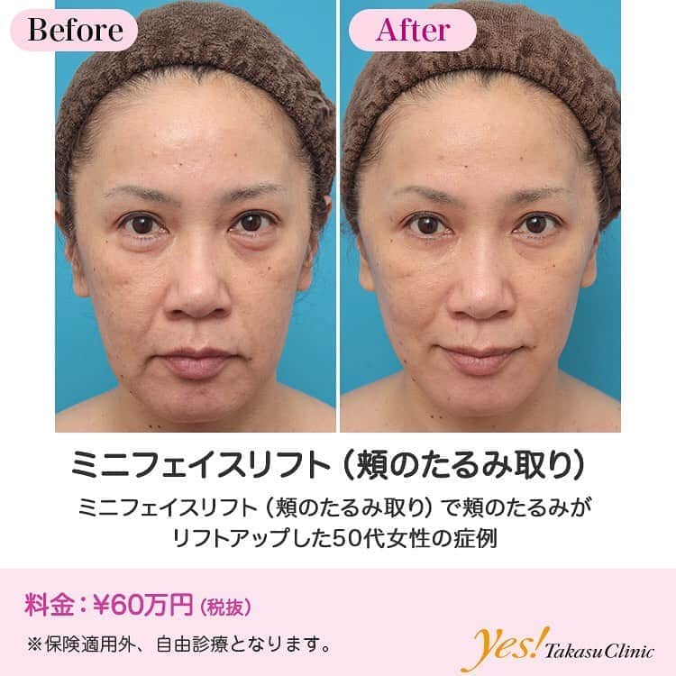 高須クリニックのインスタグラム：「👨🏻‍⚕️高須幹弥医師からのコメント✨⠀ 50代女性の患者様で、エイジングケア治療をご希望で来院されました。 診察させていただいたところ、特に顔の下半分のたるみが目立ち、頬、フェイスライン、顎下のたるみが顕著でした。 患者様は、「ダウンタイムはとれるので、多少腫れてもいいので、なるべくたるみを改善してエイジングケアしたい」というご希望だったので、切開するリフトアップ手術をすることになりました。 顔の下半分をリフトアップするための切開する手術は、切開する範囲やリフトアップ効果などにより、ミニフェイスリフト（頬のたるみ取り）~ミディアムフェイスリフト~ロワーフルフェイスリフトの3段階あります。 この患者様は、最も効果の大きいロワーフルフェイスリフトの適応がありましたが、諸事情により、ミニフェイスリフト（頬のたるみ取り）をすることになりました。 手術後は、頬、フェイスライン、顎下のたるみが程よくリフトアップされました。 また、フェイスラインのたるみが改善したことにより、シャープな輪郭になり、小顔効果もありました。 ---------------------------------------------------- 🌈料金✨⠀ ●ミニフェイスリフト（頬のたるみ取り） ¥600,000【東京、横浜、名古屋、大阪】 ---------------------------------------------------- ⚠️リスク・副作用・合併症✨⠀ ●ミニフェイスリフト（頬のたるみ取り） 切開した周辺の腫れ（術後） 仕上がりのわずかな左右差（完璧なシンメトリーは不可） 傷跡が肥厚性瘢痕やケロイドになる可能性 感覚が鈍くなる可能性 手術後の血腫 --------------------------------------------------- 😊施術についての詳細✨⠀⠀ https://www.takasu.co.jp/photo/minilift005.html ---------------------------------------------------- 📞ご予約・お問い合わせ✨⠀ 0120-5587-10⠀ https://www.takasu.co.jp/cgi-bin/form/contact.cgi ※症例写真や施術に関するご質問なども上記までお願い致します。 ---------------------------------------------------- #ミニフェイスリフト #頬のたるみ取り #頬のたるみ #たるみ改善 #リフトアップ #小顔効果  #皮膚 #美容 #美肌 #エイジングケア #美容整形 #美容外科 #美容クリニック #美容好き #美容皮膚科 #モニター #モニター募集 #高須クリニック #高須クリニック名古屋 #高須幹弥 #整形したい #プチ整形 #症例 #症例写真 #可愛くなりたい #可愛い #美人」