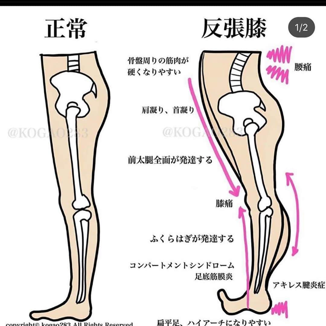 kogao283さんのインスタグラム写真 - (kogao283Instagram)「腰痛 反張膝  #太ももストレッチ❷ 大腿四頭筋は太ももの前面にある筋肉で、ひざを伸ばす膝関節の伸展動作と太ももを前に挙げる（股関節の屈曲）動作、骨盤を立てる（骨盤の前傾）動作の際に働いています。  この筋肉が硬くなると、ひざを深く曲げられなくなったり、太ももを体幹の後ろに伸ばす（股関節の伸展）動作の関節可動域が小さくなってしまいます。 筋力が弱くなると、太ももを前に高く挙げられなくなったり、ひざを真っ直ぐに伸ばす動作が困難となります。  もも前の筋肉の張り、凝りを緩和したい人、膝を曲げる動作を柔らかくしたいにオススメのストレッチです。  また 前太腿 太腿横が硬くなってるので #フォームローラー など で解す のもオススメです。 フォームローラーのやりすぎは 筋断裂をおこしますので 1箇所 30～60秒以内でお願いします✨  動画参照 フォームローラー TRIGGERᴾᴼᴵᴺᵀGRID」5月22日 10時41分 - kogao283