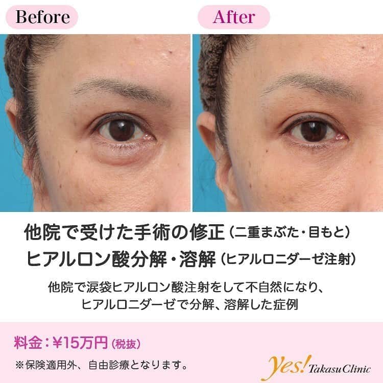 高須クリニックのインスタグラム：「👨🏻‍⚕️高須幹弥医師からのコメント✨⠀ 50代女性の患者様で、他院で涙袋にヒアルロン酸注射をしており、元に戻したいというご要望でした。 診察させていただいたところ、下まぶたの涙袋の部分が不自然に膨らみ過ぎており、涙袋というよりは、目の下のたるみの目袋のようになっていました。 ヒアルロニダーゼを注射し、入っているヒアルロン酸を全て溶かすことになりました。 ヒアルロン酸の入っている部分に、高濃度ヒアルロニダーゼを大量に注入したところ、みるみるヒアルロン酸が分解、溶解、吸収されていき、1週間後に来院されたときには完全に無くなっていました。 涙袋は本来眼輪筋という筋肉のふくらみで、若いときにあるものであり、年を取ると皮膚の張りがなくなって、筋肉が下垂し、なくなっていきます。 そのため、50代で無理して大きな涙袋をヒアルロン酸注射で作ろうとすると、目の下のたるみの目袋のようになってしまい、かえって老けてしまうことがあります。 ---------------------------------------------------- 🌈料金✨⠀ ●ヒアルロン酸分解・溶解（ヒアルロニダーゼ注射） ¥150,000【全院】 ---------------------------------------------------- ⚠️リスク・副作用・合併症✨⠀ ●ヒアルロン酸分解・溶解（ヒアルロニダーゼ注射） 内出血（注射針が血管に当たってしまった場合） アレルギーが生じる可能性 --------------------------------------------------- 😊施術についての詳細✨⠀⠀ https://www.takasu.co.jp/photo/hyaluronjyokyo006.html ---------------------------------------------------- 📞ご予約・お問い合わせ✨⠀ 0120-5587-10⠀ https://www.takasu.co.jp/cgi-bin/form/contact.cgi ※症例写真や施術に関するご質問なども上記までお願い致します。 ---------------------------------------------------- #他院で受けた手術の修正 #ヒアルロン酸分解 #ヒアルロン酸溶解 #ヒアルロニダーゼ注射 #涙袋  #皮膚 #美容 #美肌 #エイジングケア #美容整形 #美容外科 #美容クリニック #美容好き #美容皮膚科 #モニター #モニター募集 #高須クリニック #高須クリニック名古屋 #高須幹弥 #整形したい #プチ整形 #症例 #症例写真 #可愛くなりたい #可愛い #美人」