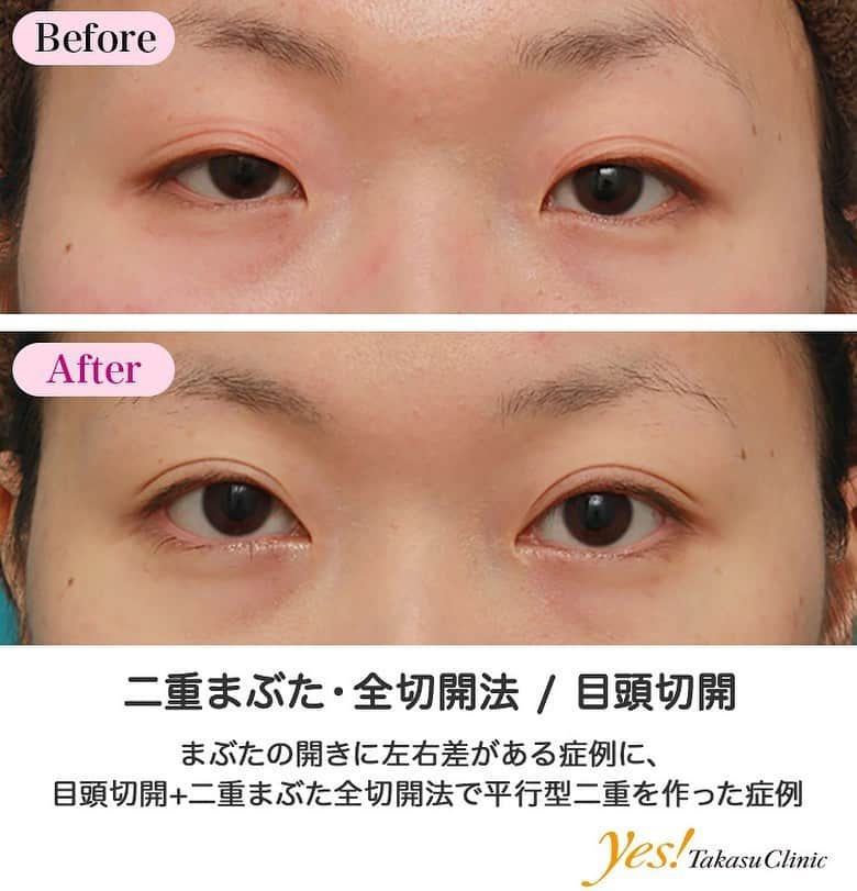 高須クリニックのインスタグラム：「👨🏻‍⚕️高須幹弥医師からのコメント✨⠀ 20代女性の患者様で、目頭切開と二重まぶた手術希望で来院されました。 診察させていただいたところ、ほぼ一重まぶたでしたが、アイプチやアイテープの癖が中途半端についており、普段作っていると思われる二重のラインがありました。 また、左に比べて右のまぶたの開きが少し悪い状態でした。 蒙古襞は適度に発達して張っていました。 まぶたの開きの左右差に関しては、眼瞼下垂の手術をすることも考慮しましたが、左右同じデザインで二重まぶた全切開法である程度改善できることが見込めたので、二重まぶた全切開法をすることになりました。 同時に目頭切開をして、目を内側に広げることになりました。 二重まぶた全切開法は、患者様の希望で、普段アイプチやアイテープをしているラインで切開して、平行型二重を作りました。 皮膚切除、眼窩内脂肪の除去、ROOFの除去はしていません。 目頭切開はZ法に準じて行い、適度に尖るデザインで1.5mmずつ内側に広げました。 術後は、まぶたの開きの左右差はわずかに残っていますが、術前に比べるとかなり改善しました。 また、患者様の希望通りの平行型二重にもなりました。 ---------------------------------------------------- 🌈料金✨⠀ ●目頭切開 片目 ¥135,000 / 両目 ¥250,000【東京、横浜、名古屋、大阪】 ●二重まぶた・全切開法 片目 ¥135,000 / 両目 ¥250,000【東京、横浜、名古屋、大阪】 脂肪切除をする場合や埋没法の糸を抜去する場合の費用も含まれております。 ---------------------------------------------------- ⚠️リスク・副作用・合併症✨⠀ ●目頭切開 内出血（術後） 仕上がりの左右差（片目ずつ手術をする場合） 仕上がりのわずかな左右差（完璧なシンメトリーは不可） 仕上がりが完璧に自分の理想の形にならないことがある ●二重まぶた・全切開法 まぶたの強い腫れ（術後／個人差があります） 内出血（術後） 仕上がりの左右差（片目ずつ手術をする場合） 不自然な二重（無理に二重の幅を広げた場合） 仕上がりのわずかな左右差（完璧なシンメトリーは不可） 仕上がりが完璧に自分の理想の形にならないことがある 二重のラインの癒着がとれる可能性 手術後の血腫 --------------------------------------------------- 😊施術についての詳細✨⠀⠀ https://www.takasu.co.jp/photo/megashira050.html ---------------------------------------------------- 📞ご予約・お問い合わせ✨⠀ 0120-5587-10⠀ https://www.takasu.co.jp/cgi-bin/form/contact.cgi ※症例写真や施術に関するご質問なども上記までお願い致します。 ---------------------------------------------------- #二重まぶた #全切開法 #全切開 #切開法 #平行型二重 #目頭切開 #まぶたの開きの左右差を改善 #二重整形 #皮膚 #美容 #美肌 #エイジングケア #美容整形 #美容外科 #美容クリニック #美容好き #美容皮膚科 #モニター #モニター募集 #高須クリニック #高須クリニック名古屋 #高須幹弥 #整形したい #プチ整形 #症例 #症例写真 #可愛くなりたい #可愛い #美人」
