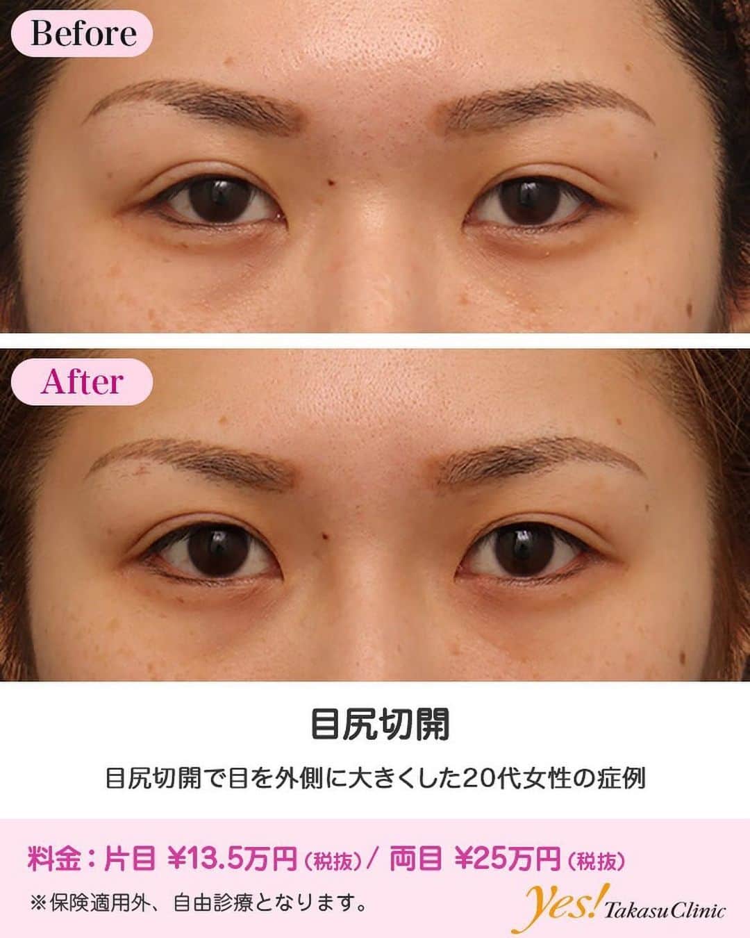 高須クリニックのインスタグラム：「👨🏻‍⚕️高須幹弥医師からのコメント✨⠀ 20代女性の患者様で、目を大きくしたいというご要望でした。 診察させていただいたところ、特別目が小さいほうではありませんでした。 しかし、一般的に「美人」「可愛い」と呼ばれている人達は、平均より目が大きい人が多いです。 この患者様は、まぶたの開きはそれなりにいいので、眼瞼下垂手術をしてまぶたの開きをこれ以上大きくすると、ギョロっとしたキツい印象の目になってしまう可能性があります。 その他の目を大きくする手術は、目頭切開、目尻切開、タレ目形成などがありますが、コンピューターシミュレーションをしてみた結果、患者様は、「まずは目尻切開で目を外側に広げたい」というご希望でした。 目尻切開で目を最大限外側に広げることになりました。 手術は、Wの字型に目尻の皮膚を切開し、目を外側に最大限広げた後、広がった部分は上下にも広がるようにしました。 結果、約2mmずつ目が外側に大きくなりました。 目尻切開は、ガラッと印象が変わるほどの大きな変化はありませんが、それなりの変化はあります。 この患者もそれなりに目が大きくなって、少し華やかな印象になりました。 ---------------------------------------------------- 🌈料金✨⠀ ●目尻切開 片目 ¥135,000 / 両目 ¥250,000【東京、横浜、名古屋、大阪】 ---------------------------------------------------- ⚠️リスク・副作用・合併症✨⠀ ●目尻切開 内出血（術後） 仕上がりの左右差（片目ずつ手術をする場合） 仕上がりのわずかな左右差（完璧なシンメトリーは不可） 仕上がりが完璧に自分の理想の形にならないことがある アートメイクが取れる可能性 --------------------------------------------------- 😊施術についての詳細✨⠀⠀ https://www.takasu.co.jp/photo/mejiri015.html ---------------------------------------------------- 📞ご予約・お問い合わせ✨⠀ 0120-5587-10⠀ https://www.takasu.co.jp/cgi-bin/form/contact.cgi ※症例写真や施術に関するご質問なども上記までお願い致します。 ---------------------------------------------------- #目尻切開 #目を外側に広げたい #目を大きくしたい  #皮膚 #美容 #美肌 #エイジングケア #美容整形 #美容外科 #美容クリニック #美容好き #美容皮膚科 #モニター #モニター募集 #高須クリニック #高須クリニック名古屋 #高須幹弥 #整形したい #プチ整形 #症例 #症例写真 #可愛くなりたい #可愛い #美人」