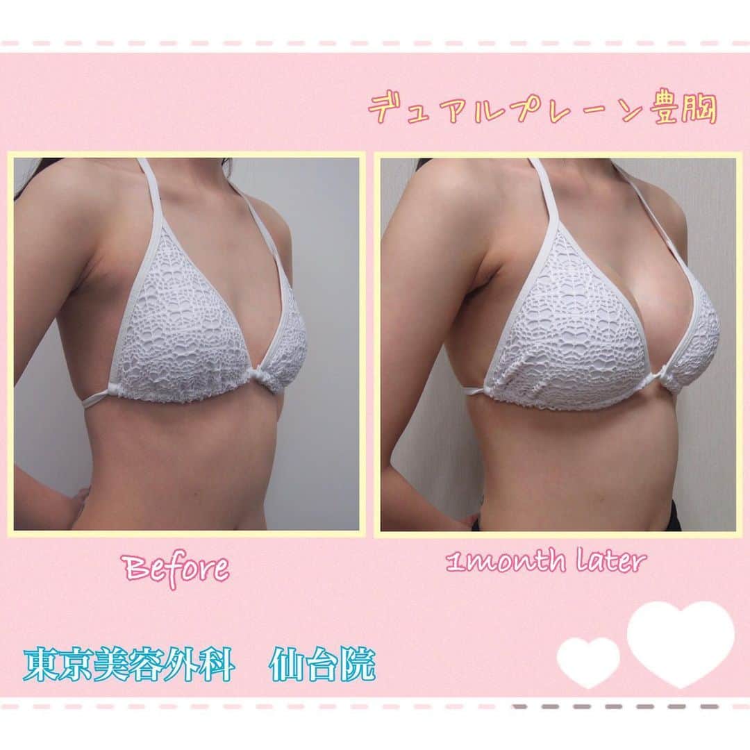 東京美容外科公式さんのインスタグラム写真 - (東京美容外科公式Instagram)「☀️東京美容外科仙台院です☀️ こちらは、豊胸手術の症例写真です📸 オペ前と、術後1ヶ月後の状態の同じ角度からの比較です😯❤️ ・ 胸の大きさがアップするだけでなく、より自然に、キレイに胸の形が出ますので気になる方は是非ドクターとカウンセリングしてみませんか？👨‍⚕️✨ 皆様に合わせた施術方法をご提案致します💁🏻‍♀️ 当院では、Webカウンセリングも行っておりますのでお気軽にご連絡ください☺️ ・ 当院では政府の緊急事態宣言をうけて ❇️ウェブカウンセリングを開始 ならびに ❇️メディカルコスメ、サプリが郵送での購入を開始致しました。 ※当院に一度でもご来院いただいたことのある方は、郵送可能です🙇‍♀️ ・ 🌷ウルトラセルQプラス ¥70,000(初回) 🌷ヴェルベットスキン ¥45,000(初回） . その他メニュー各種ございます😊💕 お気軽にお問い合わせくださいませ🍏🍎 各線「仙台駅」より徒歩5分、JR仙石線「あおば通駅」より徒歩2分 ♡ 東京美容外科 仙台院にぜひお越しください！😇 . . ====🎁お問い合わせはこちら🎁==== 詳しくはプロフィールのURLから公式サイトへ♪ ▼フリーダイヤル 0120-658-958 （コールセンター受付時間：9：00～21：00） ▼LINE予約 @ tkc110 ========================= . #東京美容外科 #東京美容外科仙台院 #仙台 #宮城 #美容 #美容整形 #整形 #美活 #綺麗になりたい #美肌 #美意識  #美容外科 #プチ整形 #エイジングケア #アンチエイジング #美容好き #韓国美容 #美容整形外科 #ヒアルロン酸 #鼻整形 #二重 #豊胸 #バストアップ #webカウンセリング始めました」5月27日 17時43分 - tokyobiyougeka_jimukyoku