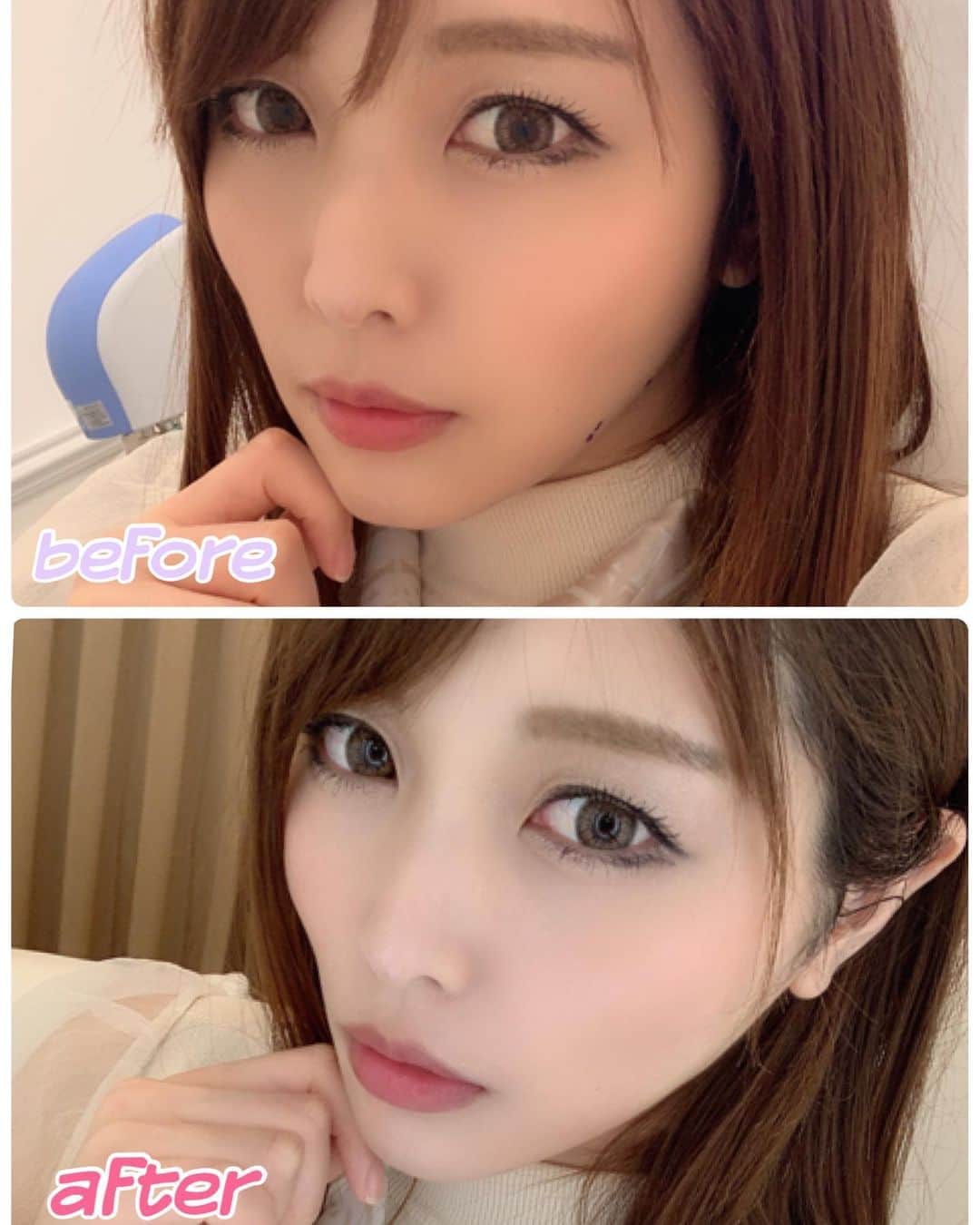 新村あかりのインスタグラム：「A CLINIC 銀座（@a_clinic_ginza ）さんで受けたAスレッドの比較画像が見たいとお声があったので載せます！ 分かりにくいかもですがフェイスラインのもたつきがなくなって全体的に引き上がった感じがします✨ 体重は変わってないのに痩せた感じもする😳‼︎ 確かな効果があるのでオススメ🔥  担当は山崎先生🌼 @dr_kanayamasaki （銀座院：@a_clinic_ginza　横浜院：@aclinic_yokohama)　柴田貴志：@drtakashibata　谷口弘樹：@dr.taniguchi 山崎香名　@dr_kanayamasaki　小松塁　@dr.komatsu_rui)  #aスレッド #小顔aスレッド #aclinic #aclinic銀座#aクリニック #エークリニック #美容 #小顔 #美肌#リフトアップ #美容外科 #美容皮膚科 #美容クリニック#山田哲雄 #柴田貴志  #谷口弘樹#山崎香名 #小松塁」