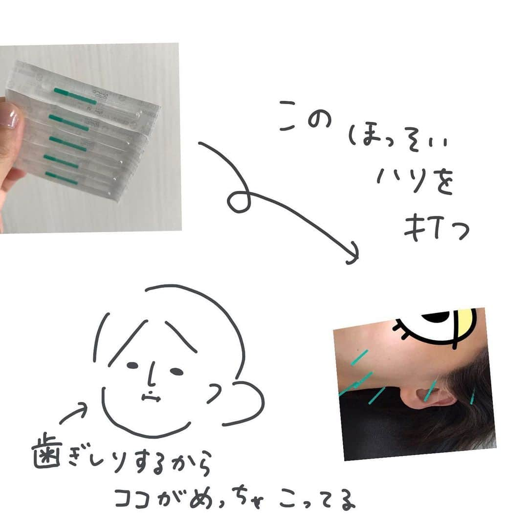 ウラクさんのインスタグラム写真 - (ウラクInstagram)「ゆかちゃんありがとう🎊 （実際にはマスクして施術してくれました😷） スッキリして勝手に超おすすめなんですが、この投稿を見たと言ってくれた方は平日限定で4,950円⇨3,980円でやってくれるそうです🕺 @coretrastudio_body . ↑(こちら) お近くの方で　#美容鍼　気になっている方ぜひに〜 . . 寝るときに歯ぎしりするからかエラがめちゃめちゃ凝っていて、ずっと美容鍼が気になってたけど針が無理なので(注射すらダメ)思いとどまってたけど初めてゆかちゃんにやってもらったら全然痛くなかった…！ 子どもたちが鍼まみれの顔を不思議そうにみてました」6月25日 7時17分 - ulaq_twins