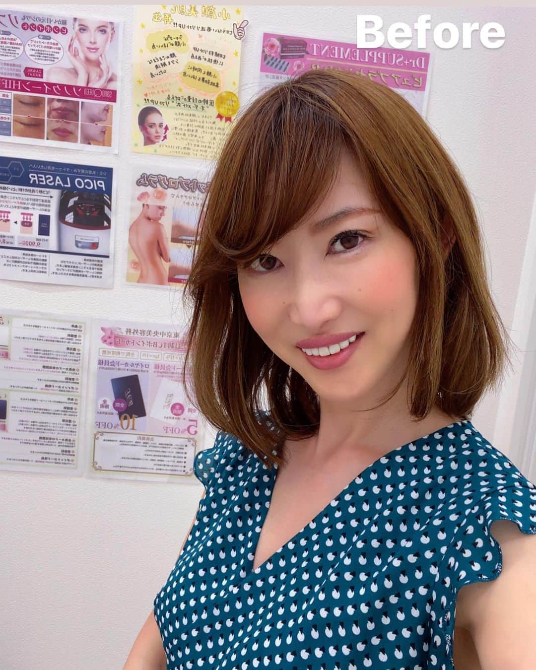 渋谷恭子さんのインスタグラム写真 - (渋谷恭子Instagram)「東京中央美容外科大宮院 @tcb_omiya  で、原田先生 @dr.harada_hiromitsu  にTCB式小顔美肌再生とほうれい線のヒアルロン酸注射の施術をして頂いてから 2週間が経ちました。 ・ ・  1カ月くらい、多少の違和感あるのは仕方ないと思ってたけど、まだ 2週間なのに違和感なくてビックリ😵 内出血もなくて、こちらも本当に嬉し過ぎる！！ ・ ・ 特殊な糸で引き上げるリフトアップ⤴️ コラーゲン増生で肌質も改善！ ・ ・ もうすぐ7月。 バストの相談も増えてきてるそうだよ。 気になるところあったら、どんな施術でも安心してお任せできる原田先生から無料カウンセリング受けてみてね！ 私のインスタ見たとお伝えすると良いことあるみたい😉💕 ・ ・ #リフトアップならTCB東京中央美容外科 #美容整形ならTCB東京中央美容外科 #東京中央美容外科 #美容外科 #大宮 #東京中央美容外科大宮院 #原田浩光 #PR #TCB式小顔美肌再生 #小顔美肌再生 #リフトアップ」6月26日 6時53分 - kyoko.86