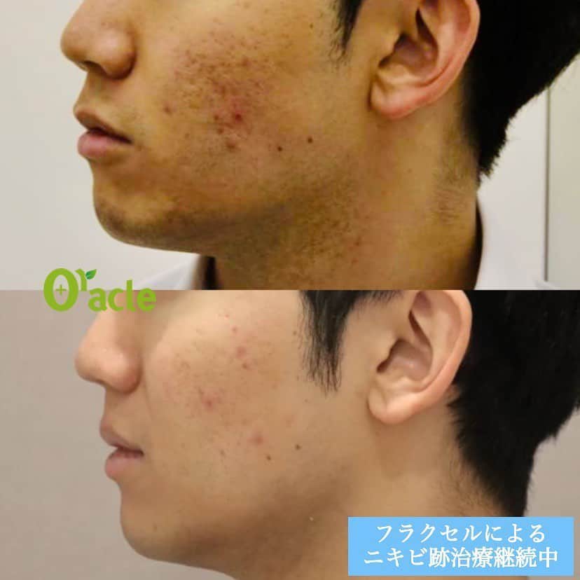 オラクル美容皮膚科東京新宿院さんのインスタグラム写真 - (オラクル美容皮膚科東京新宿院Instagram)「🔹メンズニキビ治療🔹﻿ 上記治療内容﻿ ☑️アグネス 3回﻿ ☑️BHAピーリング 3回﻿ ﻿ ニキビの炎症が落ち着いたため、現在フラクセルによるニキビ跡治療を継続中です。﻿ ﻿ オラクル美容皮膚科は新宿東口からすぐの場所柄、男性の患者様もとても多いです。﻿ ﻿ ニキビ！モニター募集中﻿ +‥‥‥‥‥‥‥‥‥‥+﻿ ☆施術紹介☆﻿ ﻿ アグネス﻿ ➡ニキビの元となる皮脂腺をRF(ラジオ波)によって一つ一つ破壊していく施術です。﻿ ニキビの再発を長期的に防ぐことができ、繰り返しできるニキビでお悩みの方におすすめです💡﻿ ﻿ BHAピーリング﻿ ➡️高い殺菌力と抗炎症作用のあるサリチル酸を使ったピーリングです。﻿ 角質や毛穴の中の皮脂を溶かし、排出を促します。﻿ ダウンタイムや痛みもなく、ニキビができづらいお肌に導きます✨﻿ ﻿ +‥‥‥‥‥‥‥‥‥‥+﻿ 【料金】﻿ ﻿ モニターの場合は、複数回（症状により異なります）の治療が必要となります。﻿ モニターの方はすべての治療費から半額となります。﻿ ﻿ 下記は1回の治療料金です。﻿ 【料金】﻿ 〇アグネス﻿ 部分1回20,000円(税抜)[片側:顎・頬・こめかみ]﻿ 全顔1回80,000円(税抜)﻿ ﻿ 〇BHAピーリング﻿ 1回10,000円(税抜)﻿ ﻿ ○ジェネシス﻿ 1回10,000円（税抜）﻿ ※ニキビの赤みを抑えハリ艶を出すレーザーピーリングです。﻿ ﻿ ○シンデレラ点滴﻿ 1回　5,500円（税抜）﻿ ※抗酸化力の高いビタミンCを含む点滴﻿ ﻿ ○メソナJ ニキビ撃退コース﻿ 1回　25,000円（税抜）﻿ ﻿ +‥‥‥‥‥‥‥‥‥‥+﻿ 【モニター条件】﻿ ・モニター適用かどうかは、ドクターの診察が必要です。﻿ ・20歳以上の方﻿ ・写真や動画を雑誌・HP・SNSなどの広告メディアへの掲載に同意していただける方(目元モザイクあり)﻿ ・事前に全回数分の料金のお支払いが可能な方﻿ ﻿ ﻿ リスクなど⚠️﻿ アグネスは稀に腫れや赤みのや色素沈着などが見られる場合があります。BHAは施術中のピリピリ感を感じます﻿ ﻿ ▪️▫️▪️▫️▪️▫️▪️▫️▪️▫️﻿ ﻿ 🇯🇵オラクル美容皮膚科🇰🇷﻿ 📍新宿3丁目19-4 MLJ新宿8階﻿ ﻿ 【専門】﻿ ニキビ（跡）／毛穴／シミ／しわ／たるみ／痩身／アンチエイジング／美白美肌治療全般／ブライダル相談／メンズ美容﻿ ﻿ 🗝完全予約制﻿ 👠土日祝日も診療﻿ ﻿ 【予約方法】﻿ ☎0120-905-696﻿ ⏰9:00～21:00［年中無休］﻿ ﻿ LINE、メール24時間📧﻿ LINE🆔 @oracle.jp ﻿ 📩HPメールフォームよりお願いいたします﻿ ﻿ ﻿ ▪️▫️▪️▫️▪️▫️▪️▫️▪️▫️﻿ ﻿ #オラクル美容皮膚科 #オラクル ﻿ #oracle #韓国美容 #美容皮膚科 ﻿ #皮膚科 #美容 #小顔矯正 #コラーゲン #美容オタク #美容マニア #ヒアルロン酸 #弾力 #ハリ #美白 #保湿 #ゆらぎ肌 #일본피부과 #오라클피부과 #リフトアップ #シワ #美肌 #美肌ケア #肌管理 #韓国美容皮膚科 #乾燥 #ニキビ #皮脂 #ニキビケア #ニキビ跡ケア」6月26日 9時09分 - oraclejp