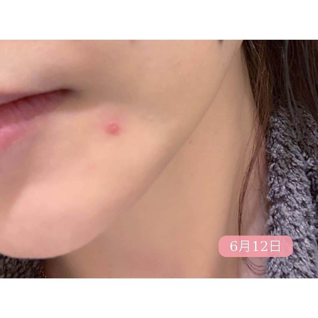 石井美保さんのインスタグラム写真 - (石井美保Instagram)「そういえば少し前にお話ししたニキビ(吹出物)の経過。 6月21日にはコンシーラがいらないほどに色素沈着も改善しました。(1枚目2枚目共にお風呂前後の何も塗っていない状態なのでお見苦しい感じで恐縮ですが)治りの速さと色素沈着改善はルミエラブのおかげと、芯を出した後1回アクロパスを貼ったこと(postしてあります)、そして今日postしたアクネオのおかげ。マスクの下にパウダーを仕込んで対処してました。 6月12日を見るとニキビも酷いけど、周りの肌も揺らいでますよね。マスク、本当に辛いですが今は仕方ないから、対処法を手に入れてください。 因みにニキビはジクジクしているところを超えて枯れてきたらRicheのレタッチピーリングをすることでかなり回復します。ただ今ご新規様が沢山ご来店頂いているためなかなかマシンが空いてなく、私はまだレタッチピーリングはできていないのですが、そろそろやりたいタイミング。」6月27日 0時04分 - miho_ishii