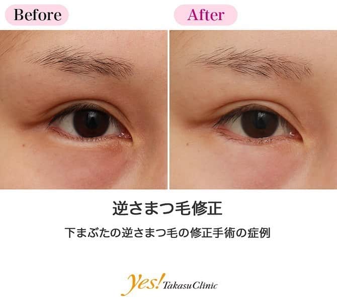 高須クリニックのインスタグラム：「👨🏻‍⚕️高須幹弥医師からのコメント✨⠀ 20代女性の患者様で、右目の下まぶたの逆さまつ毛の修正手術希望で来院されました。 診察させていただいたところ、右目の下まぶたのまつ毛が、かなり内側（眼球側）に向いて生えていました。 特に中央部分のまつ毛が内側に向いて生えており、まつ毛が常に黒目に当たっていて、角膜に痛みが生じている状態でした。 左目は逆さまつ毛にはなっておらず、正常でした。 右目の下まぶたの逆さまつ毛修正手術をすることになりました。 局所麻酔下に、下まぶたの余分な皮膚を約2mmの幅で切除し、まつ毛側の皮膚を瞼板に癒着させるように縫合固定しました。 術後はまつ毛が外向きになり、逆さまつ毛が改善しました。 下まぶたの盛り上がっている余分な皮膚を切除し、まつ毛が外向きに生えるようになったので、目が大きく見えるようにもなりました。 ---------------------------------------------------- 🌈料金✨⠀ ●逆さまつ毛修正 上まぶた（片目） ¥135,000【東京、横浜、名古屋、大阪】 / 上まぶた（両目） ¥250,000【東京、横浜、名古屋、大阪】 / 下まぶた（片目） ¥135,000【東京、横浜、名古屋、大阪】 / 下まぶた（両目） ¥250,000【東京、横浜、名古屋、大阪】 / 埋没法上まぶた（片目） ¥50,000【全院】 / 埋没法上まぶた（両目） ¥90,000【全院】 ---------------------------------------------------- ⚠️リスク・副作用・合併症✨⠀ ●逆さまつ毛修正 内出血（術後） ヒアルロン酸注射による涙袋が作りにくくなる 仕上がりのわずかな左右差（完璧なシンメトリーは不可） 手術時に下まぶたのまつ毛がカットされる ヒアルロン酸がわずかに出る アートメイクが取れる可能性 --------------------------------------------------- 😊施術についての詳細✨⠀⠀ https://www.takasu.co.jp/photo/trichiasis001.html ---------------------------------------------------- 📞ご予約・お問い合わせ✨⠀ 0120-5587-10⠀ https://www.takasu.co.jp/cgi-bin/form/contact.cgi ※症例写真や施術に関するご質問なども上記までお願い致します。 ---------------------------------------------------- #逆さまつ毛 #逆さまつ毛修正 #逆さまつ毛修正手術 #逆さまつ毛改善 #下まぶたの逆さまつ毛 #下まぶたの逆さまつ毛修正  #皮膚 #美容 #美肌 #エイジングケア #美容整形 #美容外科 #美容クリニック #美容好き #美容皮膚科 #モニター #モニター募集 #高須クリニック #高須クリニック名古屋 #高須幹弥 #整形したい #プチ整形 #症例 #症例写真 #可愛くなりたい #可愛い #美人」