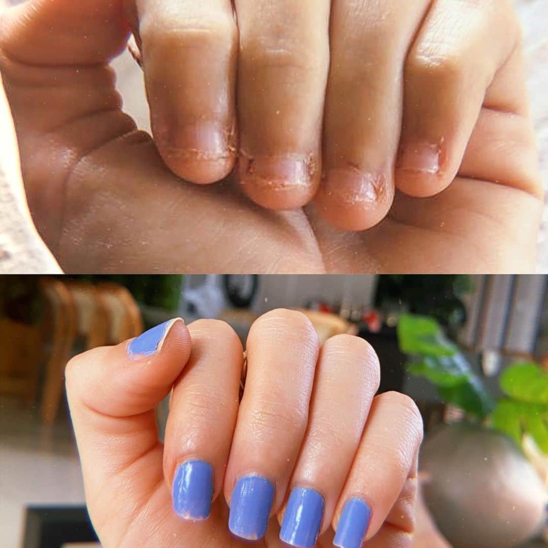 Gabriela Salesのインスタグラム：「3 meses separam as duas fotos. Nunca mostrei minhas unhas de perto pra vocês, isso sempre foi um problema pra mim. Não é só estética, é, principalmente, saúde! Pra uns é só uma unha roída, pra mim representa muitos anos de crises de ansiedade e dor. Sim, pra unha roída chegar nesse ponto, dói bastante. Dói quando encosta em algum objeto, dói quando sangra, quando encosta na água, dói quando julgam também. Incrivelmente, mesmo no ápice da minha ansiedade (ainda tenho crises), consegui parar de roer unha aos 32 anos. E espero que dessa vez seja pra sempre. Queria usar esse post de forma colaborativa pra gente compartilhar dicas de roedoras e ex roedoras de unhas. O que ajuda/ajudou vocês a parar de roer?」