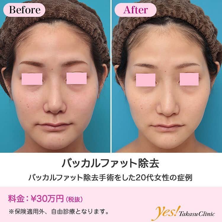 高須クリニックのインスタグラム：「👨🏻‍⚕️高須幹弥医師からのコメント✨⠀ 20代女性の患者様で、バッカルファット除去手術希望で来院されました。 診察させていただいたところ、頬が膨らんで、適度にバッカルファットが発達しているのがわかりました。 また、適度に皮下脂肪もついていました。 バッカルファットに対してはバッカルファット除去手術が有効であり、皮下脂肪に対しては小顔専用脂肪溶解注射メソシェイプフェイスなどの脂肪溶解注射が有効であり、両方の治療をするのが理想ですが、まずはバッカルファット除去手術のみをすることになりました。 口の中の頬の内側の粘膜から、片側につき、Sサイズ鶏卵の黄身くらいの大きさのバッカルファットを、左右の頬から摘出しました。 術後は頬のバッカルファットの部分の膨らみが少しすっきりしました。 この後、小顔専用脂肪溶解注射メソシェイプフェイスで頬、フェイスライン、顎下などの皮下脂肪を除去すると、更に小顔になってすっきりします。 ---------------------------------------------------- 🌈料金✨⠀ ●バッカルファット除去 ¥300,000 【東京、横浜、名古屋、大阪】 ---------------------------------------------------- ⚠️リスク・副作用・合併症✨⠀ ●バッカルファット除去 手術後に処方する抗生剤や痛みどめによるアレルギー症状 --------------------------------------------------- 😊施術についての詳細✨⠀⠀ https://www.takasu.co.jp/photo/buccalfat013.html ---------------------------------------------------- 📞ご予約・お問い合わせ✨⠀ 0120-5587-10⠀ https://www.takasu.co.jp/cgi-bin/form/contact.cgi ※症例写真や施術に関するご質問なども上記までお願い致します。 ---------------------------------------------------- #バッカルファット #バッカルファット除去 #頬の膨らみ  #皮膚 #美容 #美肌 #エイジングケア #美容整形 #美容外科 #美容クリニック #美容好き #美容皮膚科 #モニター #モニター募集 #高須クリニック #高須クリニック名古屋 #高須幹弥 #整形したい #プチ整形 #症例 #症例写真 #可愛くなりたい #可愛い #美人」
