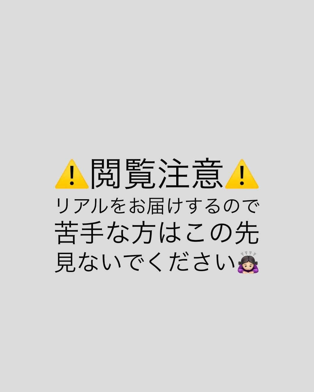 芹澤明日香さんのインスタグラム写真 - (芹澤明日香Instagram)「. . ⚠️閲覧注意⚠️ ▶︎▶︎スライドしてね▶︎▶︎ . ちょっと遅くなっちゃったんだけど、、 おでこにぷるぷる注射をして1ヶ月後の経過観察で やってみたかった【ダーマペン】をやったの‼️ やりたい施術ではあったけど痛さが怖かった… でも案内してくれるスタッフさんもやった話を 聞いたりナースの方のお話し聞いて頑張ろうと思えた😌 . PRPなので自分の血液から採取した細胞因子を使うよ💉 麻酔をたっぷり塗ってドキドキ… . ▶︎▶︎5枚目 針の深さは毛穴など気になるとこは2.5mm 顔まわりや骨の近くは2mmでやってくれたけど 麻酔してても痛いよ😅😅😅 でも綺麗になる為だから我慢できる😎 そのあとPRPをお肌に塗ってパック✨ . 麻酔してても痛いよ💦 【ダーマペン】って細い針で微細な穴をあけて PRPをお肌の真皮層までダイレクトに入れるの！ 真皮の自己治癒力とPRPの美肌再生産作用の 相乗効果によって老化した肌もニキビ跡など修復！！ . 施術当日はとにかく真っ赤で日焼けした感じ🙌🏼 2〜3日目は毛穴が内出血のようになったり かさぶたっぽくなったり皮剥けたり👐🏼 1週間くらいすると赤みは消えてきて少し皮剥け！ 指示どうり保湿しまくって摩擦起きないようにしてたら いつのまにかちゅるちゅるぷるぷる肌に🥚✨ . 綺麗になるには痛みのリスクやダウンタイムが あるけど綺麗になるなら我慢できる😎 . とにかく毛穴やみかん肌、苺鼻（肌）肌を 綺麗にするならダーマペンが1番オススメ‼️ 普通のダーマペンより、自分の血液から採取した PRPをとってやる方がより効果的🤓✨ 私はおでこもダーマペンもPRPでお肌ぷるぷる❤️ . なんかね @pruge_clinic の先生もナースの方も すごい良い方で安心してできるし施術中も詳しく 丁寧に教えてくれたり痛くても一緒に頑張りましょう みたいな感じでほんと癒されるクリニック🏥💕 1ヶ月経ったからまたダーマペンやろうと思ったけど 先生がまだ肌再生中だから2ヶ月あけた方が良いかもと 言われたのでダーマペンは来月にすることに✨ この日はエレクトロポーレーションをやったの🥳 またレポします📝✨✨ . . . #プルージュ美容クリニック #赤羽クリニック  #prp #ぷるぷる注射 #再生美容 #アンチエイジング  #若返り #再生医療 #シングルマザー #美容オタク #ダーマペン #美容レポ #美容好きな人と繋がりたい  #美容好き #美肌ケア #美肌になりたい #シンママ  #女の子ママ #アラフォーママ #ママでも綺麗に #momlife #beauty #beautyclinic #girlsmom」6月9日 11時01分 - 1219asuka