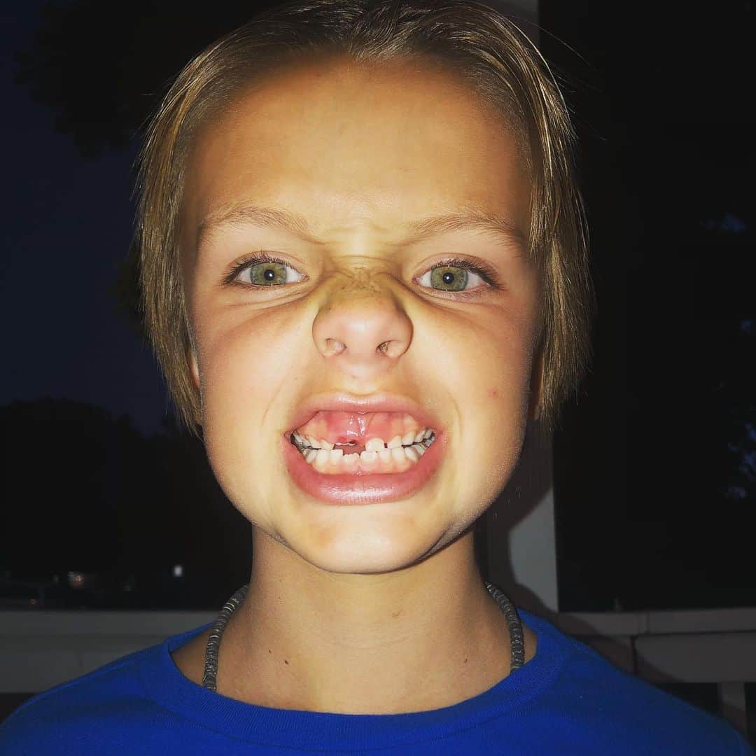 トニー・アゼベドのインスタグラム：「Third tooth lost!」