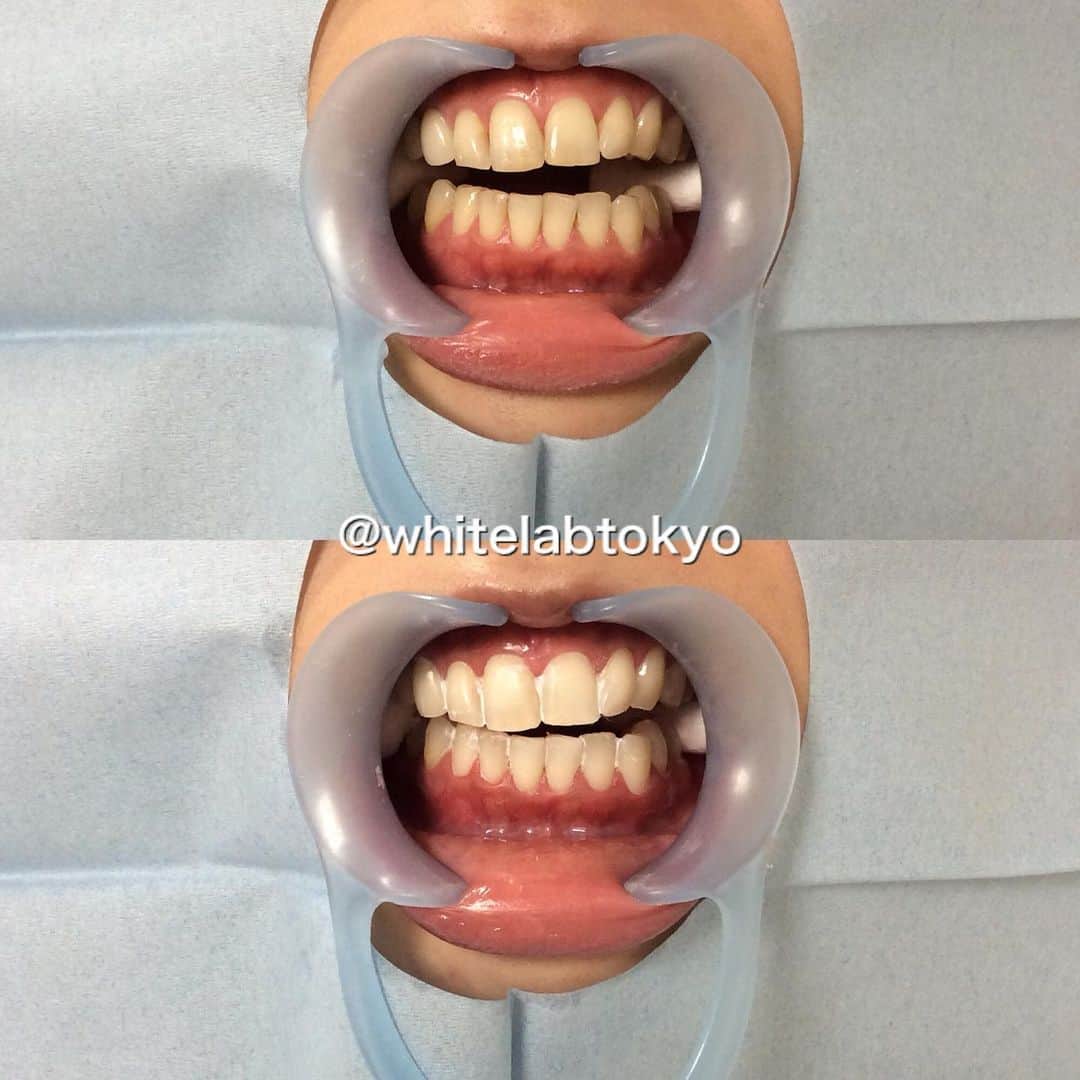 ホワイトニング専門クリニック ホワイトラボ東京 渋谷さんのインスタグラム写真 - (ホワイトニング専門クリニック ホワイトラボ東京 渋谷Instagram)「* #歯のホワイトニング @whitelabtokyo * 明日から東京も梅雨ですね☔️ 体調を崩しやすい時期ですので皆さまどうか無理せず御自愛下さい。 * * #医療ホワイトニング は実は歯を白くするだけではありません！ 歯に付いてしまった細かい汚れ＝細菌 を 浮かせて取り除く効果もあります✨ #口臭 #虫歯 でお悩みの方にも実はオススメです。 * * #ホワイトラボ東京 では歯科医師と歯科衛生士が施術を担当致します。 #歯磨き の仕方が分からない、相談したい、などがありましたら 気楽にお声かけ下さい😊🙆‍♀️ * * #歯磨き #綺麗な歯 #ホワイトニング渋谷 #ホワイトニング銀座 #ソーシャルディスタンス #平日が狙い目 #オフィスホワイトニング #歯を白くする #ブライダル #ブライダルホワイトニング #ブライダルホワイトニングならホワイトラボ東京 #前撮り #就活の面接 #第一印象を良くする #婚活 #自分磨き #きれいになりたい #清潔感 #イケメン」6月10日 18時29分 - whitelabtokyo