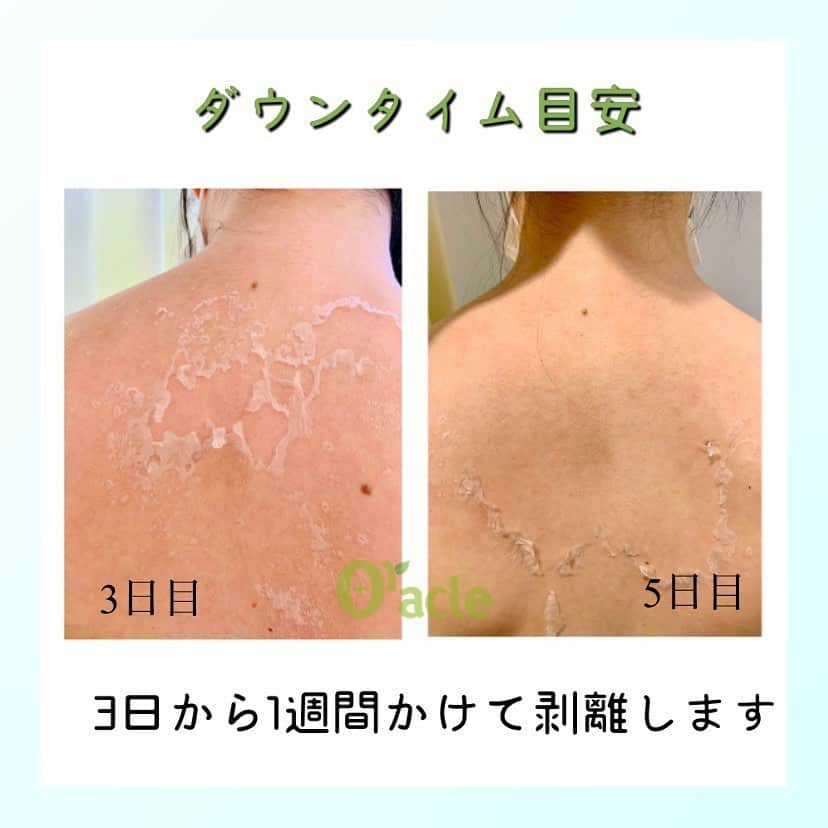 オラクル美容皮膚科東京新宿院さんのインスタグラム写真 - (オラクル美容皮膚科東京新宿院Instagram)「こんにちは 안녕하세요~🥰﻿ 皮膚管理スタッフのiです( ^‿^ )ㅤㅤㅤㅤㅤㅤㅤㅤㅤㅤㅤㅤㅤ﻿ 私が定期的に受けているオススメの施術🌱﻿ アラジンピーリング🌱﻿ はこれからの季節にぴったりです！ㅤㅤㅤㅤㅤㅤㅤㅤㅤㅤㅤㅤㅤ﻿ ﻿ 汗をたくさんかき、肌のベタつきや皮脂つまり、ニキビができやすくなる今の時期からアラジンピーリングを受けてます😊👌ㅤㅤㅤㅤㅤㅤㅤㅤㅤㅤㅤㅤㅤ﻿ ﻿ お顔以外の部位、背中や腕、膝や脚までどこでも施術可能です✨ㅤㅤㅤㅤㅤㅤㅤㅤㅤㅤㅤㅤㅤ﻿ ﻿ 背中のザラつきやニキビが気になっていたので最近、これからの薄着対策として背中のアラジンピーリングを受けました🙆‍♀️🌱﻿ (写真で背中の経過をぜひ見てください)ㅤㅤㅤㅤㅤㅤㅤㅤㅤㅤㅤㅤㅤ﻿ ﻿ 1度の施術でもザラつき解消﻿ ニキビ軽減を実感できます﻿ 数回行っていくことで更に効果実感を得られるかと思います🌟ㅤㅤㅤㅤㅤㅤㅤㅤㅤㅤㅤㅤㅤ﻿ ﻿ 🉐🉐🉐﻿ ６月キャンペーンも行っています‼️ㅤㅤㅤㅤㅤㅤㅤㅤㅤㅤㅤㅤㅤ﻿ ✅1グラム ￥12.500→￥9.800﻿ ✅3グラム ￥37.500→￥28.000﻿ ✅5グラム ￥62.000→￥45.000﻿ ※税抜です﻿ ﻿ 🎁エスベルのアロエジェル付きㅤㅤㅤㅤㅤㅤㅤㅤㅤㅤㅤㅤㅤ﻿ ﻿ エスベル アロエジェルはオラクルでしか購入することのできないコスメです😉👍🏻﻿ ﻿ 刺激がなく、どんなお肌にも使用可能なためピーリングやレーザー後のお肌に最適です🧏🏻‍♀️🧏🏻‍♂️ㅤㅤㅤㅤㅤㅤㅤㅤㅤㅤㅤㅤㅤㅤㅤㅤㅤㅤㅤㅤㅤㅤㅤㅤㅤㅤ﻿ エスベル アロエジェル付きは、普段していないメニューになりますのでぜひこの機会に施術をうけてみてください😉♡﻿ ﻿ ﻿ ▪️▫️▪️▫️▪️▫️▪️▫️▪️▫️﻿ ﻿ 【ダウンタイムについて】﻿ 赤み1〜3日程度﻿ 剥離 3〜7日くらい ﻿ 【注意点】﻿ ・当日は顔を濡らさないようにする。﻿ ・入浴、運動、飲酒は2-3日控える﻿ ・保湿しっかり﻿ ﻿ ﻿ ▪️▫️▪️▫️▪️▫️▪️▫️▪️▫️﻿ ﻿ 🇯🇵オラクル美容皮膚科🇰🇷﻿ 📍新宿3丁目19-4 MLJ新宿8階﻿ ﻿ 【専門】﻿ ニキビ（跡）／毛穴／シミ／しわ／たるみ／痩身／アンチエイジング／美白美肌治療全般／ブライダル相談﻿ ﻿ 🗝完全予約制﻿ 👠土日祝日も診療﻿ ﻿ 【予約方法】﻿ ☎0120-905-696﻿ ⏰9:00～21:00［年中無休］﻿ ﻿ LINE、メール24時間📧﻿ LINE🆔 @oracle.jp ﻿ 📩HPメールフォームよりお願いいたします﻿ ﻿ ▪️▫️▪️▫️▪️▫️▪️▫️▪️▫️﻿ ﻿ #オラクル美容皮膚科 #オラクル #美容皮膚科 #韓国美容 #水光注射﻿ #ハーブピーリング　#ピーリング　#ニキビ﻿ #ニキビ跡　#ニキビ治療　#メンズ美容﻿ #美容好きな人と繋がりたい ﻿ #韓国好きな人と繋がりたい ﻿ #韓国好きな人と仲良くなりたい ﻿ #韓国女子 #美容オタク」6月11日 9時32分 - oraclejp