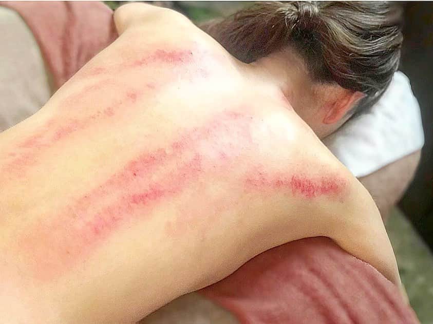 能美黎子さんのインスタグラム写真 - (能美黎子Instagram)「・ コロナ太りを解消するために 解除明けにまず向かったのは、 通っている 「 ハン・サロン　@hansalondevisage 」 ・ 身体の毒素を抜いてくれる 体内浄化コースを受けてきました。 ・ 2か月ぶりに受けたら、 かなり溜まっていて最初に受けた時のように がっつりと身体に出ました。 ・ この赤い斑点が全て毒素。 最初受けた時はあまりにも衝撃で、 びっくりしてしまいましたが、 これが病みつきになるんです。 ・ 施術後、2.3日すると 身体が本当に楽になって軽い、 そして身体の調子が良い！ 肩こりとかもなくなって、 とにかく私の身体には合っているみたい。 ・ ✔︎疲労回復 ✔︎免疫力アップ ✔︎デトックス ✔︎ダイエット ・ 気になる方は是非こちらをご覧下さい。→ @hansalondevisage  電話番号→0364238510 ・ #ハンサロン#コロナ太り #韓国美容 #体内浄化 #韓国エステ #美容day#毒素排出 #疲労回復 #免疫力アップ #お得なキャンペーン #東京エステ #美容好きな人と繋がりたい #美意識高い人と繋がりたい #デトックス#アンチエイジング#東京女子部#コロナに負けるな #アラサー美容#美body #小顔#リフトアップ#エステ #キャンペーン実施中 #ダイエット#お得情報 #驚きの効果 #コロナ対策 #コスメコンシェルジュ #미용#좋아요」6月11日 20時11分 - reikonohmi