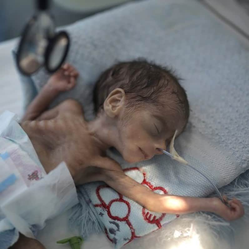 ティモシー・サイクスのインスタグラム：「⚠️WARNING: GRAPHIC IMAGES⚠️ CLICK THE LINK IN @karmagawa BIO TO HELP THE CHILDREN IN YEMEN! There are many issues in the world right now, but none are more urgent than in Yemen where one child is dying every 10 minutes due to a lack of food, water and medicine so we MUST help them! Everyone needs to see what’s happening here so please share this post with your followers and tag people, celebrities, influencers & news media because not enough people know that Yemen is the largest humanitarian crisis in the world, with more than 24 million people, 80% of the population, including more than 12 million children, in need of urgent help right now! Click the link in our bio to see our charity fundraiser as we are now 70% of the way to achieving our goal of raising $500,000 to help the children and people of Yemen with badly needed food, water and medicine and all donations, great and small, are much appreciated. Sadly, with coronavirus now breaking out across the country, Yemen is facing the biggest emergency in its history as food prices have doubled in the past month alone so let’s use our social media platforms to spread massive awareness about this crisis by sharing this post with your followers & encouraging everyone to also share with their followers & tagging celebrities, influencers and news media who need to see this too — let’s work together to make EVERYONE aware of this urgent crisis that will kill millions of people & children in the next few weeks/months if we do nothing…SHARE & CLICK THE LINK IN @karmagawa BIO TO HELP YEMEN RIGHT NOW! #saveyemen #prayforyemen #yemen #karmagawa」