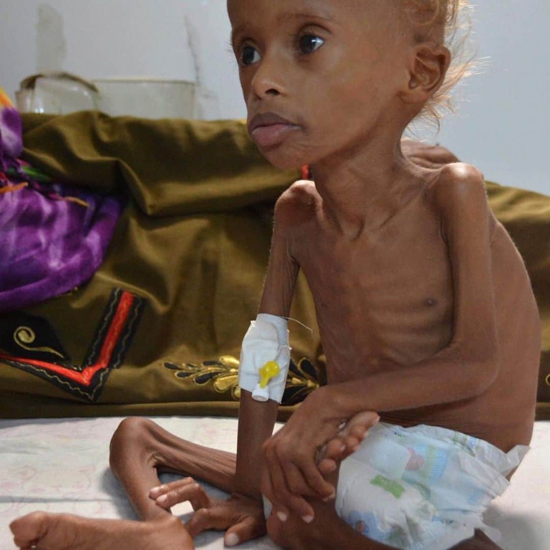 ティモシー・サイクスさんのインスタグラム写真 - (ティモシー・サイクスInstagram)「⚠️WARNING: GRAPHIC IMAGES⚠️ CLICK THE LINK IN @karmagawa BIO TO HELP THE CHILDREN IN YEMEN! There are many issues in the world right now, but none are more urgent than in Yemen where one child is dying every 10 minutes due to a lack of food, water and medicine so we MUST help them! Everyone needs to see what’s happening here so please share this post with your followers and tag people, celebrities, influencers & news media because not enough people know that Yemen is the largest humanitarian crisis in the world, with more than 24 million people, 80% of the population, including more than 12 million children, in need of urgent help right now! Click the link in our bio to see our charity fundraiser as we are now 70% of the way to achieving our goal of raising $500,000 to help the children and people of Yemen with badly needed food, water and medicine and all donations, great and small, are much appreciated. Sadly, with coronavirus now breaking out across the country, Yemen is facing the biggest emergency in its history as food prices have doubled in the past month alone so let’s use our social media platforms to spread massive awareness about this crisis by sharing this post with your followers & encouraging everyone to also share with their followers & tagging celebrities, influencers and news media who need to see this too — let’s work together to make EVERYONE aware of this urgent crisis that will kill millions of people & children in the next few weeks/months if we do nothing…SHARE & CLICK THE LINK IN @karmagawa BIO TO HELP YEMEN RIGHT NOW! #saveyemen #prayforyemen #yemen #karmagawa」6月29日 6時22分 - timothysykes