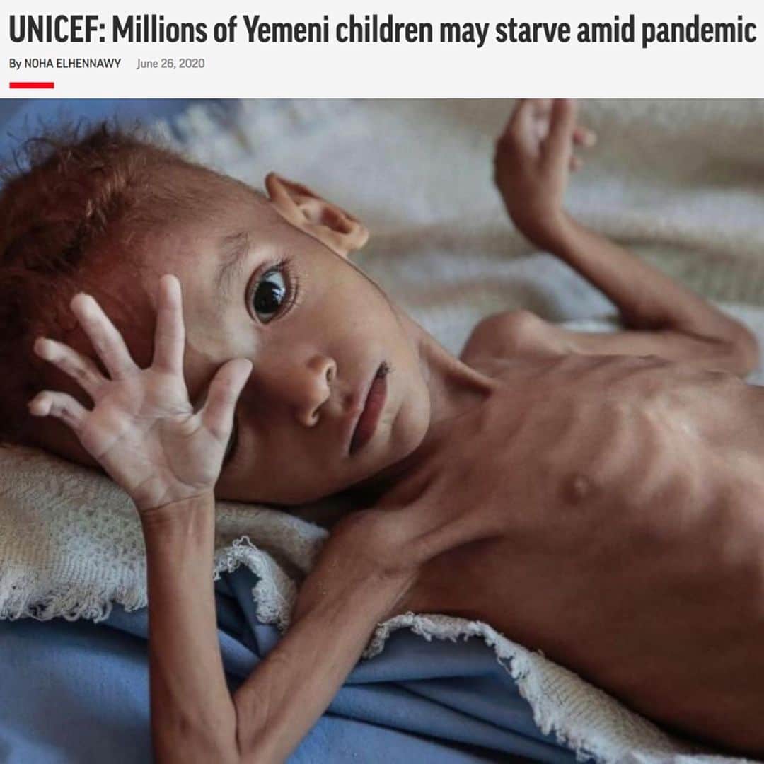 ティモシー・サイクスさんのインスタグラム写真 - (ティモシー・サイクスInstagram)「⚠️WARNING: GRAPHIC IMAGES⚠️ CLICK THE LINK IN @karmagawa BIO TO HELP THE CHILDREN IN YEMEN! There are many issues in the world right now, but none are more urgent than in Yemen where one child is dying every 10 minutes due to a lack of food, water and medicine so we MUST help them! Everyone needs to see what’s happening here so please share this post with your followers and tag people, celebrities, influencers & news media because not enough people know that Yemen is the largest humanitarian crisis in the world, with more than 24 million people, 80% of the population, including more than 12 million children, in need of urgent help right now! Click the link in our bio to see our charity fundraiser as we are now 70% of the way to achieving our goal of raising $500,000 to help the children and people of Yemen with badly needed food, water and medicine and all donations, great and small, are much appreciated. Sadly, with coronavirus now breaking out across the country, Yemen is facing the biggest emergency in its history as food prices have doubled in the past month alone so let’s use our social media platforms to spread massive awareness about this crisis by sharing this post with your followers & encouraging everyone to also share with their followers & tagging celebrities, influencers and news media who need to see this too — let’s work together to make EVERYONE aware of this urgent crisis that will kill millions of people & children in the next few weeks/months if we do nothing…SHARE & CLICK THE LINK IN @karmagawa BIO TO HELP YEMEN RIGHT NOW! #saveyemen #prayforyemen #yemen #karmagawa」6月29日 6時22分 - timothysykes