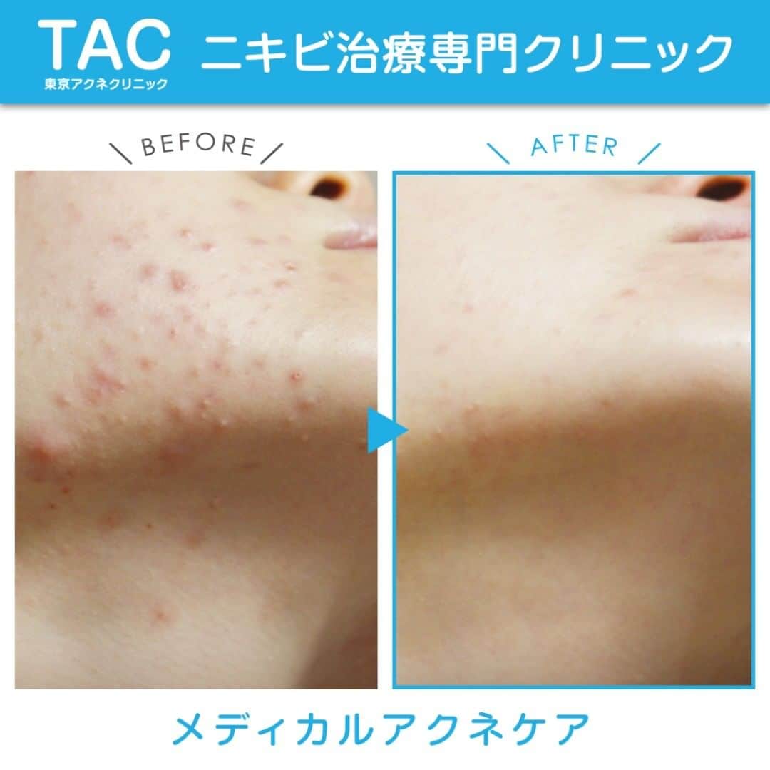 東京アクネクリニックさんのインスタグラム写真 - (東京アクネクリニックInstagram)「\\ニキビを二度と繰り返さないために…メディカルアクネケア//﻿ ﻿ 当院のメディカルアクネケアは、ニキビができる原因となる「皮脂腺」一つ一つに微細な針を挿入し通電することで﻿ ダイレクトに異常皮脂腺を破壊します⚡️﻿ ﻿ ニキビの原因を排除し、再発する可能性の低い根本ニキビ治療です！﻿ ﻿ 繰り返すニキビにお悩みの方は「東京アクネクリニック」までお気軽にご相談ください💚☺️﻿ ﻿ +:-:+:-:+:-:+:-:+:-:+:-:+:-:+:-:+:-:+﻿ ﻿ 📷症例写真　20代女性﻿ 【治療メニュー】﻿ メディカルアクネケア6回、アクネピーリング6回﻿ ﻿ +:-:+:-:+:-:+:-:+:-:+:-:+:-:+:-:+:-:+﻿ ﻿ 【料金】﻿ メディカルアクネケア﻿ 鼻、鼻下[各1箇所] 20,000円﻿ 額全体、首、顎ライン[各1箇所]　40,000円﻿ ﻿ アクネピーリング　セット1回　30,000円﻿ ﻿ +:-:+:-:+:-:+:-:+:-:+:-:+:-:+:-:+:-:+﻿ ﻿ 🏥東京アクネクリニック﻿ ﻿ 📲フリーダイヤル　0120-90-5541﻿ ※コールセンター受付時間 9:00～21：00﻿ ﻿ お問い合わせはプロフィールのURLから！﻿ +:-:+:-:+:-:+:-:+:-:+:-:+:-:+:-:+:-:+﻿ ﻿ #ニキビ #大人ニキビ #吹き出物 #ニキビ跡 #ニキビ肌改善 #ニキビ治療 #肌荒れ #ニキビケア #ニキビ改善 #肌荒れ改善 #美肌治療 #美肌 #美肌ケア #美容皮膚科 #皮膚科 #エステ #ピーリング #肌質改善 #すっぴん #スキンケア #ニキビ予防 #メディカルアクネケア﻿ #赤ニキビ　#黒ニキビ　#黄ニキビ﻿ #ニキビ治療専門」6月15日 10時51分 - nikibi.c