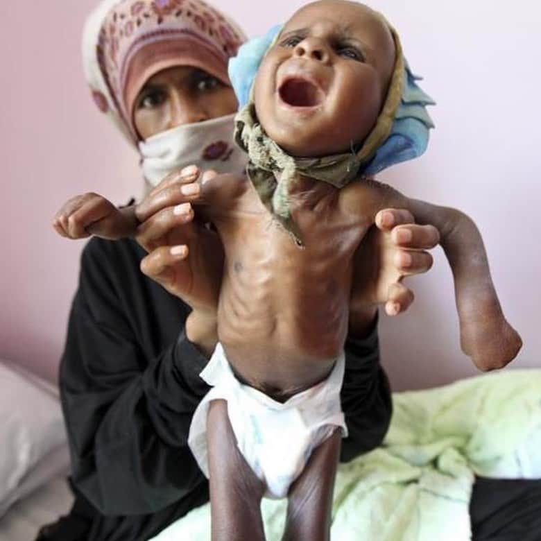 ティモシー・サイクスさんのインスタグラム写真 - (ティモシー・サイクスInstagram)「⚠️WARNING: GRAPHIC IMAGES⚠️ Repost from @karmagawa WE MUST HELP THE CHILDREN OF YEMEN WHO ARE DYING EVERY DAY NOW! Click the link in the @karmagawa bio to see the fundraiser we started with the initial goal of raising $200,000 to help the millions of children in Yemen who urgently need food, water, medicine & shelter because right now one child is dying every 10 minutes every day right now! No child deserves to starve to death or be in this much pain so all donations, great and small, are most appreciated and the money will be donated to two hardworking charities already on the ground: Unicef Yemen and Save The Children Yemen. Even if you can’t donate much, sharing our new fundraiser with your followers helps tremendously too as we must all work together to spread awareness about this crisis all over social media to raise desperately needed funds to prevent any more children from dying RIGHT NOW! Please also share this post with your followers and tag people, celebrities, influencers & news media who need to see this too because sadly not enough people are talking about this crisis and if we continue to do nothing then many more innocent children will die in the next few week/months, SO LET’S GET HELP FOR THESE CHILDREN RIGHT NOW! #yemencrisis #saveyemen #prayforyemen #yemen #karmagawa」6月16日 10時40分 - timothysykes