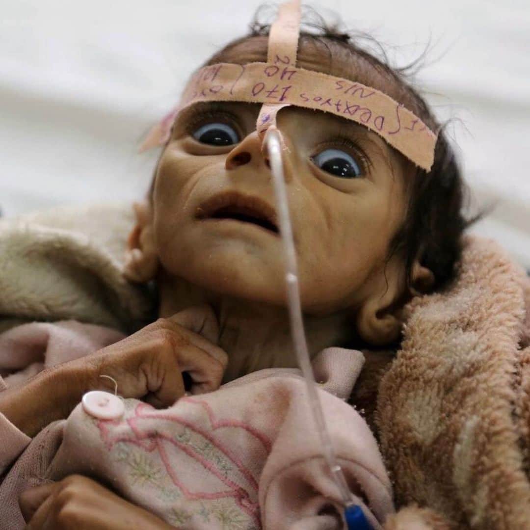 ティモシー・サイクスのインスタグラム：「⚠️WARNING: GRAPHIC IMAGES⚠️ Repost from @karmagawa WE MUST HELP THE CHILDREN OF YEMEN WHO ARE DYING EVERY DAY NOW! Click the link in the @karmagawa bio to see the fundraiser we started with the initial goal of raising $200,000 to help the millions of children in Yemen who urgently need food, water, medicine & shelter because right now one child is dying every 10 minutes every day right now! No child deserves to starve to death or be in this much pain so all donations, great and small, are most appreciated and the money will be donated to two hardworking charities already on the ground: Unicef Yemen and Save The Children Yemen. Even if you can’t donate much, sharing our new fundraiser with your followers helps tremendously too as we must all work together to spread awareness about this crisis all over social media to raise desperately needed funds to prevent any more children from dying RIGHT NOW! Please also share this post with your followers and tag people, celebrities, influencers & news media who need to see this too because sadly not enough people are talking about this crisis and if we continue to do nothing then many more innocent children will die in the next few week/months, SO LET’S GET HELP FOR THESE CHILDREN RIGHT NOW! #yemencrisis #saveyemen #prayforyemen #yemen #karmagawa」